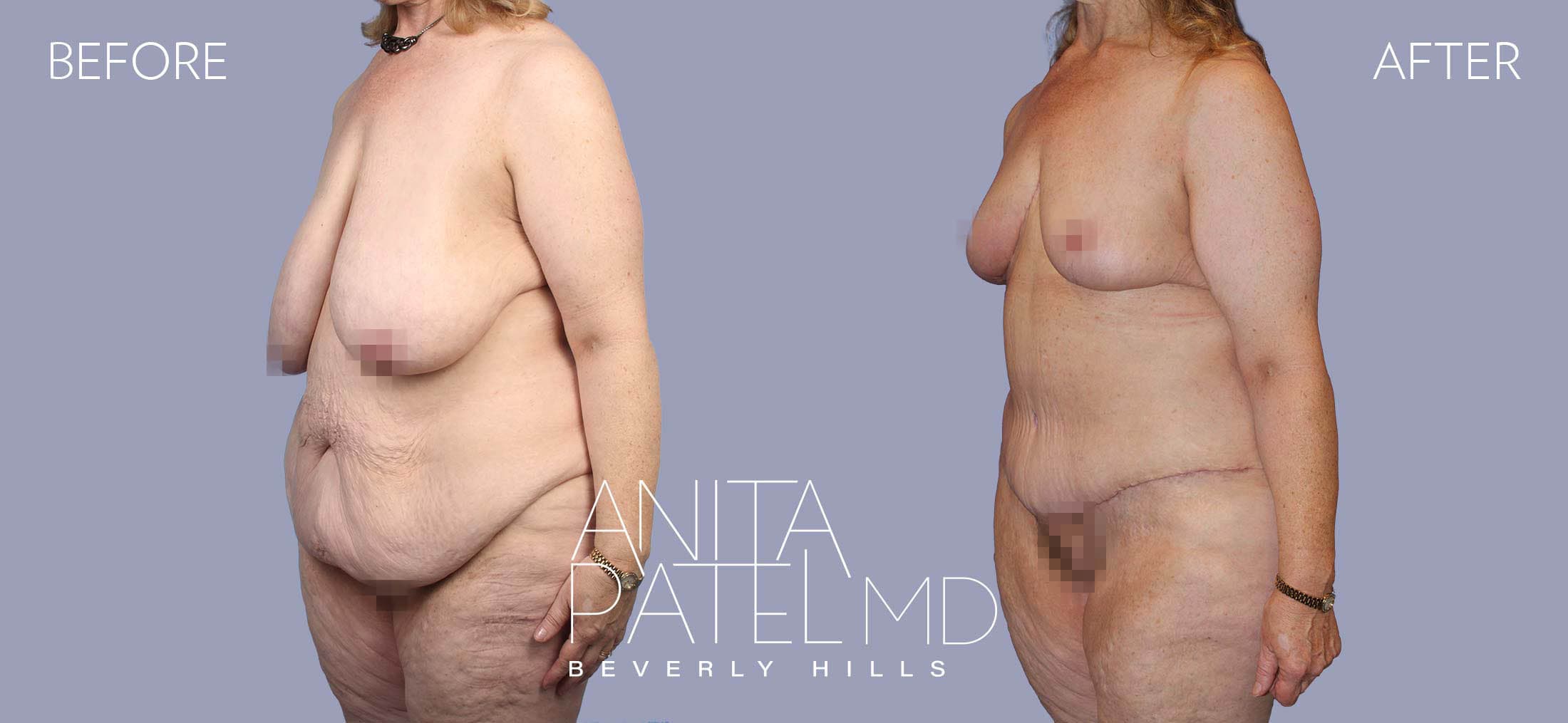 Lift Contour before and after — Patient 2, photo 4 of 5 — Dr. Anita Patel, MD, FACS, Beverly Hills