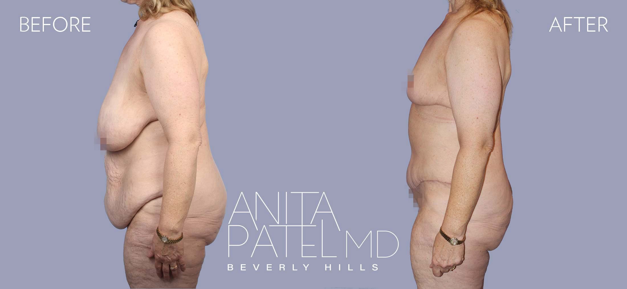 Lift Contour before and after — Patient 2, photo 5 of 5 — Dr. Anita Patel, MD, FACS, Beverly Hills