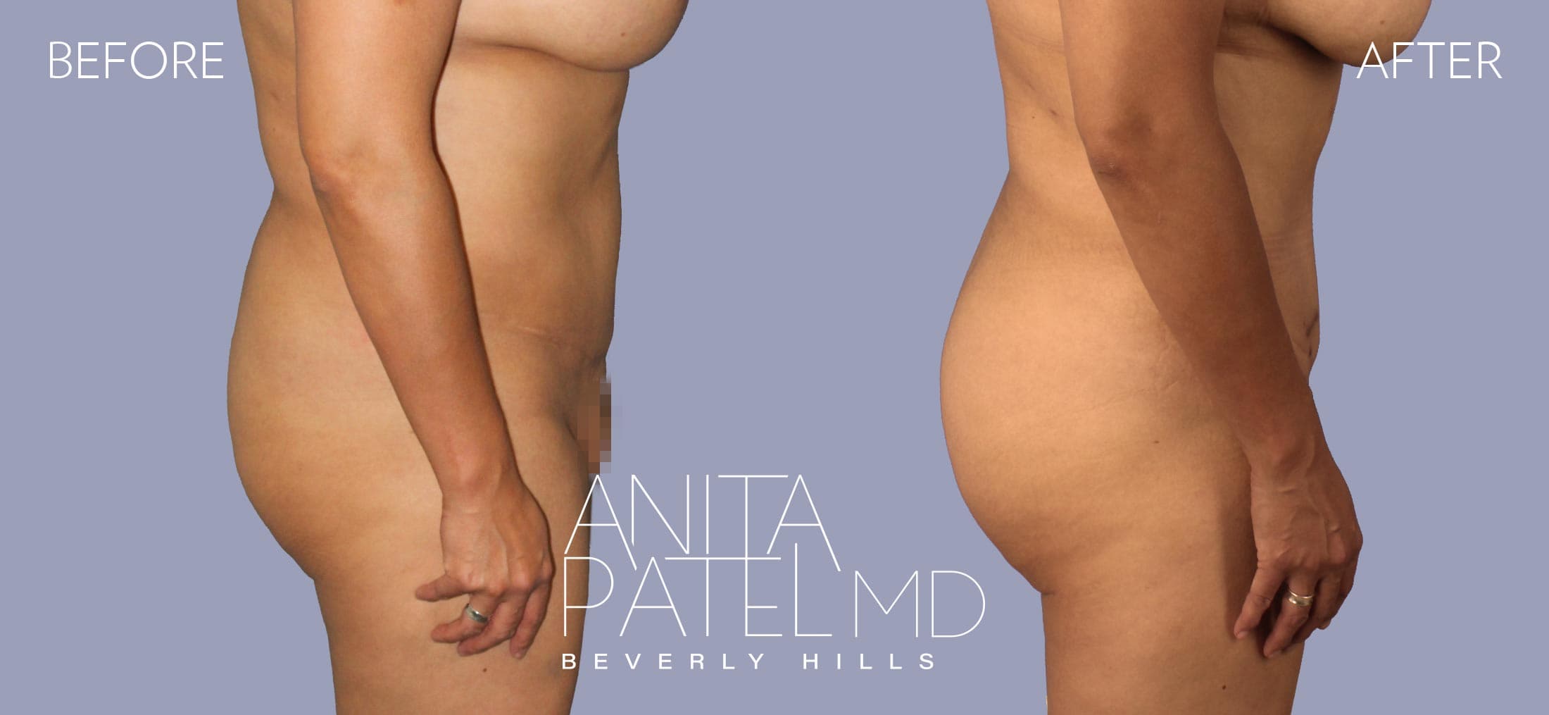 Brazilian Butt Lift before and after — Patient 2, photo 2 of 2 — Dr. Anita Patel, MD, FACS, Beverly Hills