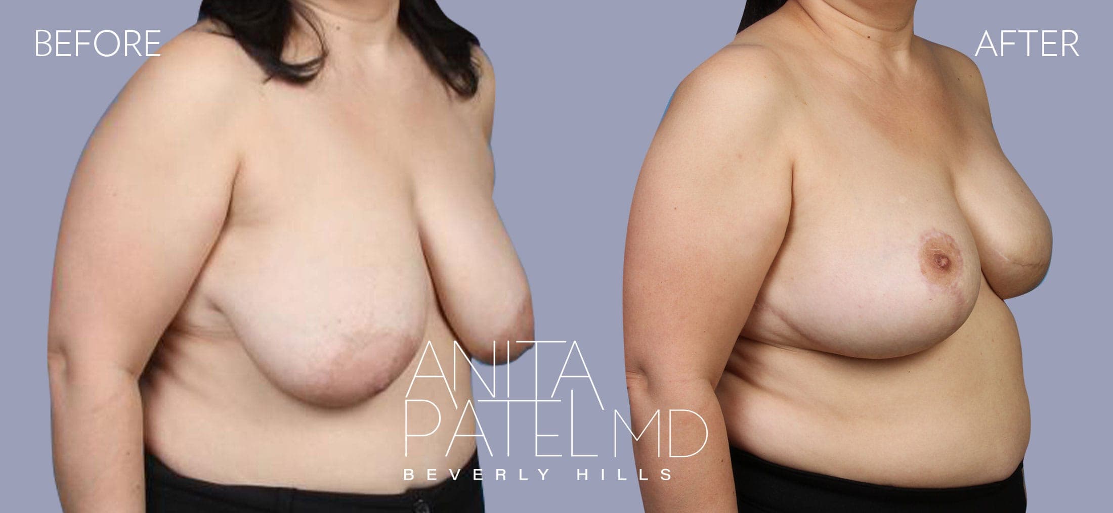 Breast Reconstruction before and after — Patient 1, photo 2 of 2 — Dr. Anita Patel, MD, FACS, Beverly Hills