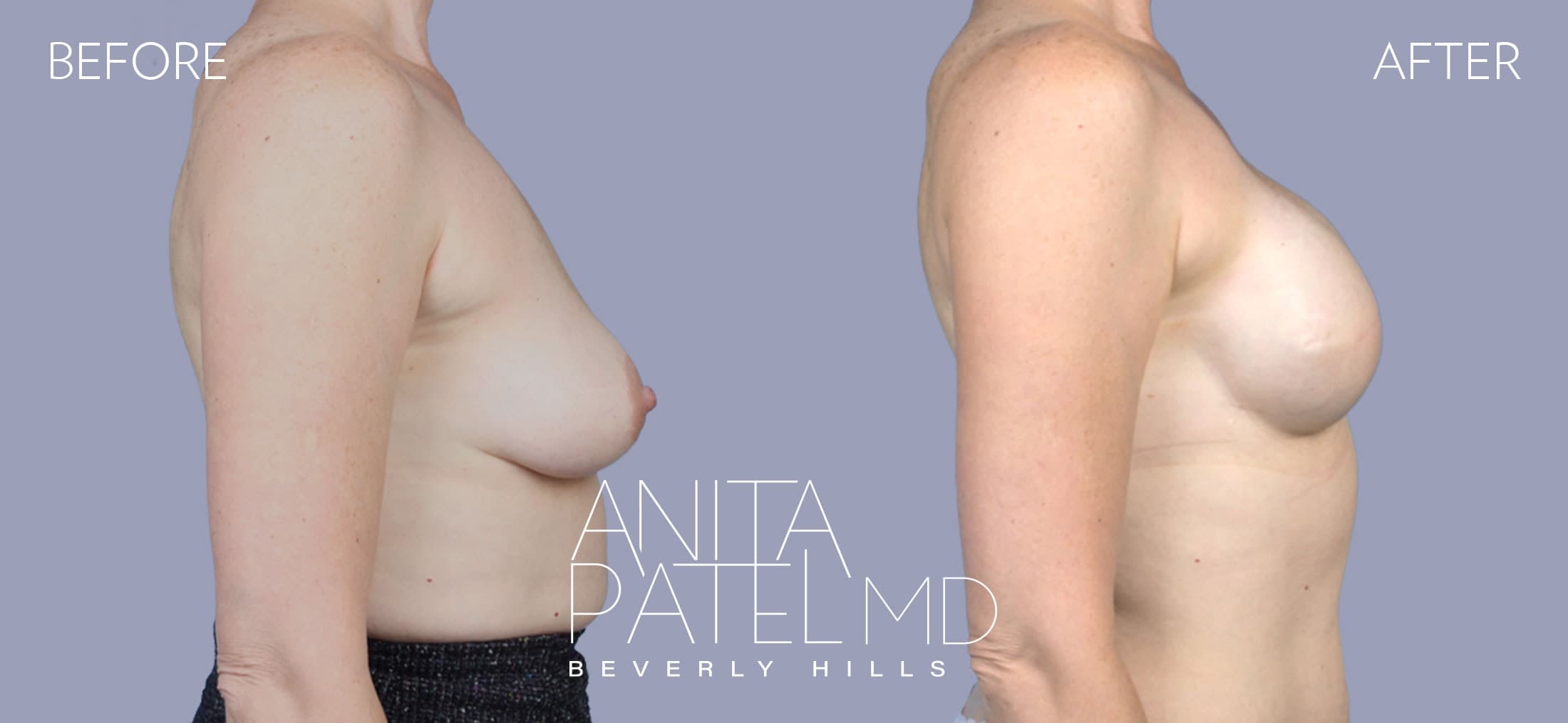 Breast Reconstruction before and after — Patient 2, photo 2 of 2 — Dr. Anita Patel, MD, FACS, Beverly Hills