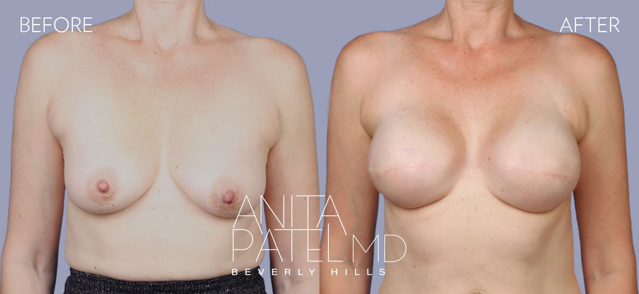 Breast Reconstruction before and after — Patient 2, photo 1 of 2 — Dr. Anita Patel, MD, FACS, Beverly Hills