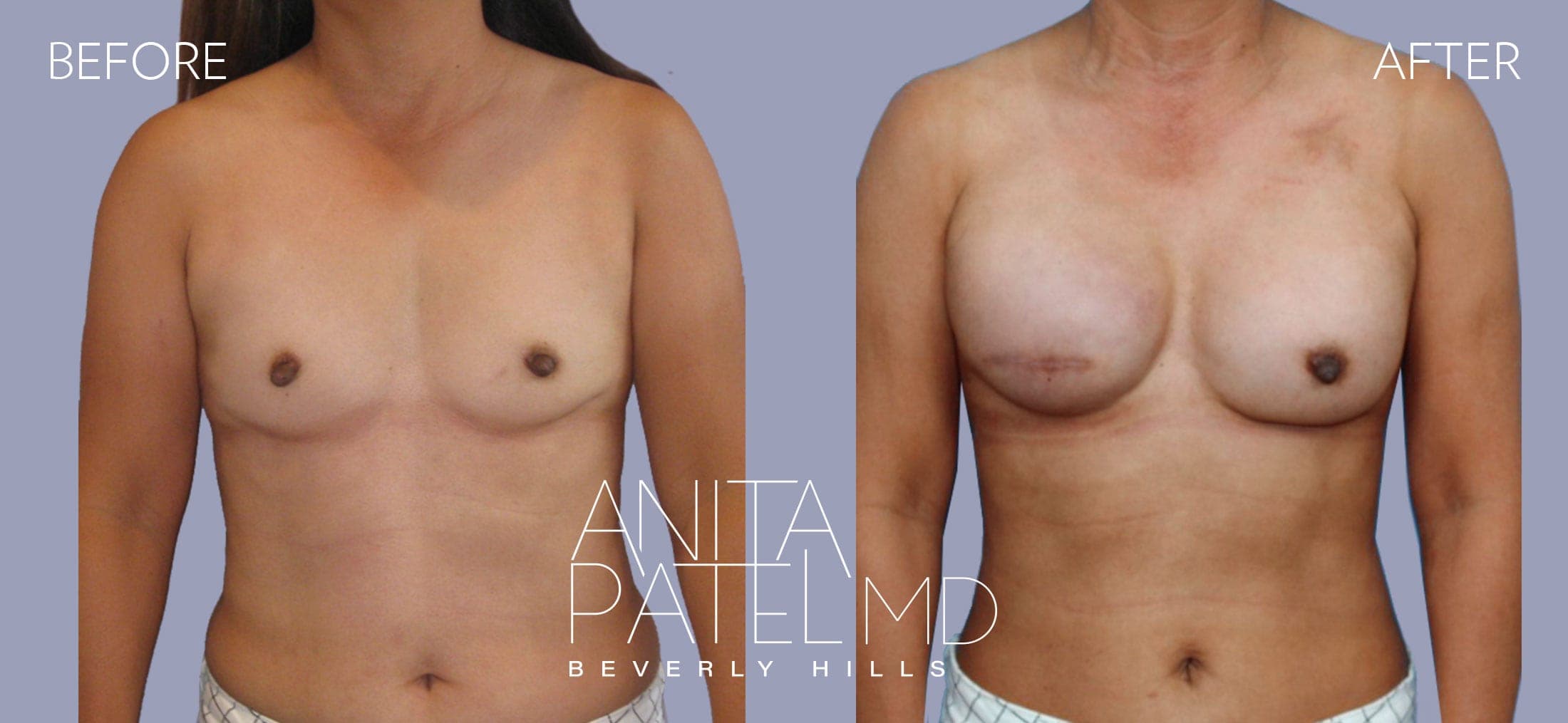 Breast Reconstruction before and after — Patient 7, photo 1 of 5 — Dr. Anita Patel, MD, FACS, Beverly Hills