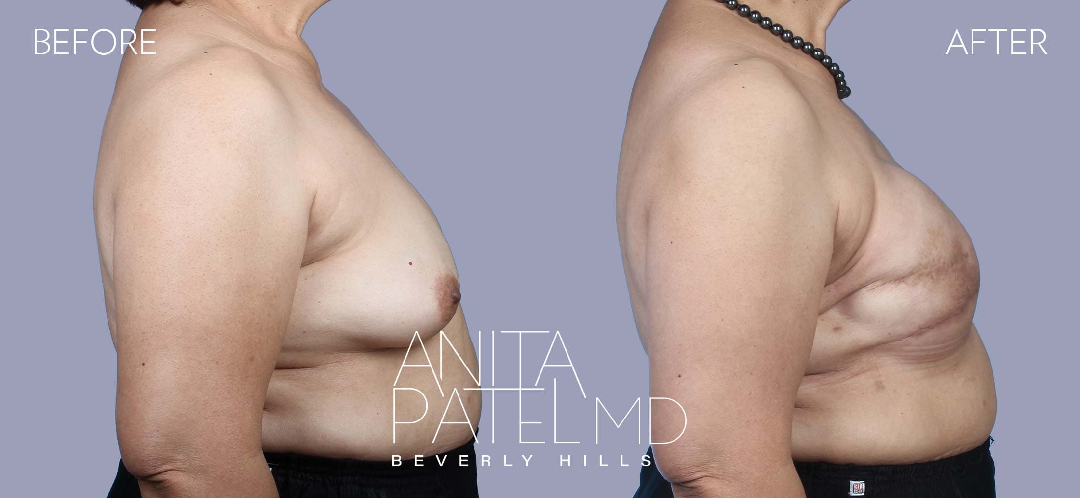 Breast Reconstruction before and after — Patient 3, photo 1 of 2 — Dr. Anita Patel, MD, FACS, Beverly Hills