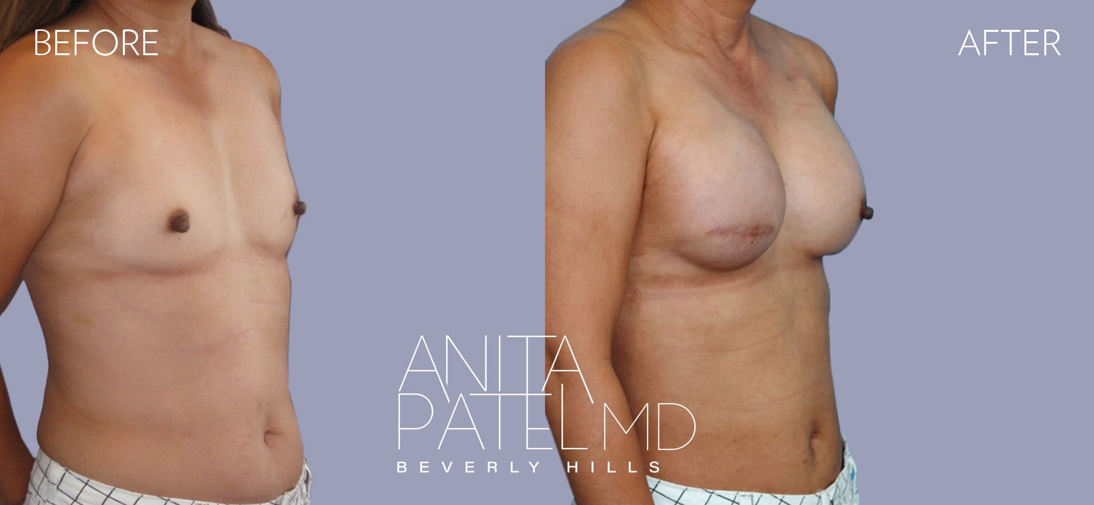 Breast Reconstruction before and after — Patient 7, photo 2 of 5 — Dr. Anita Patel, MD, FACS, Beverly Hills