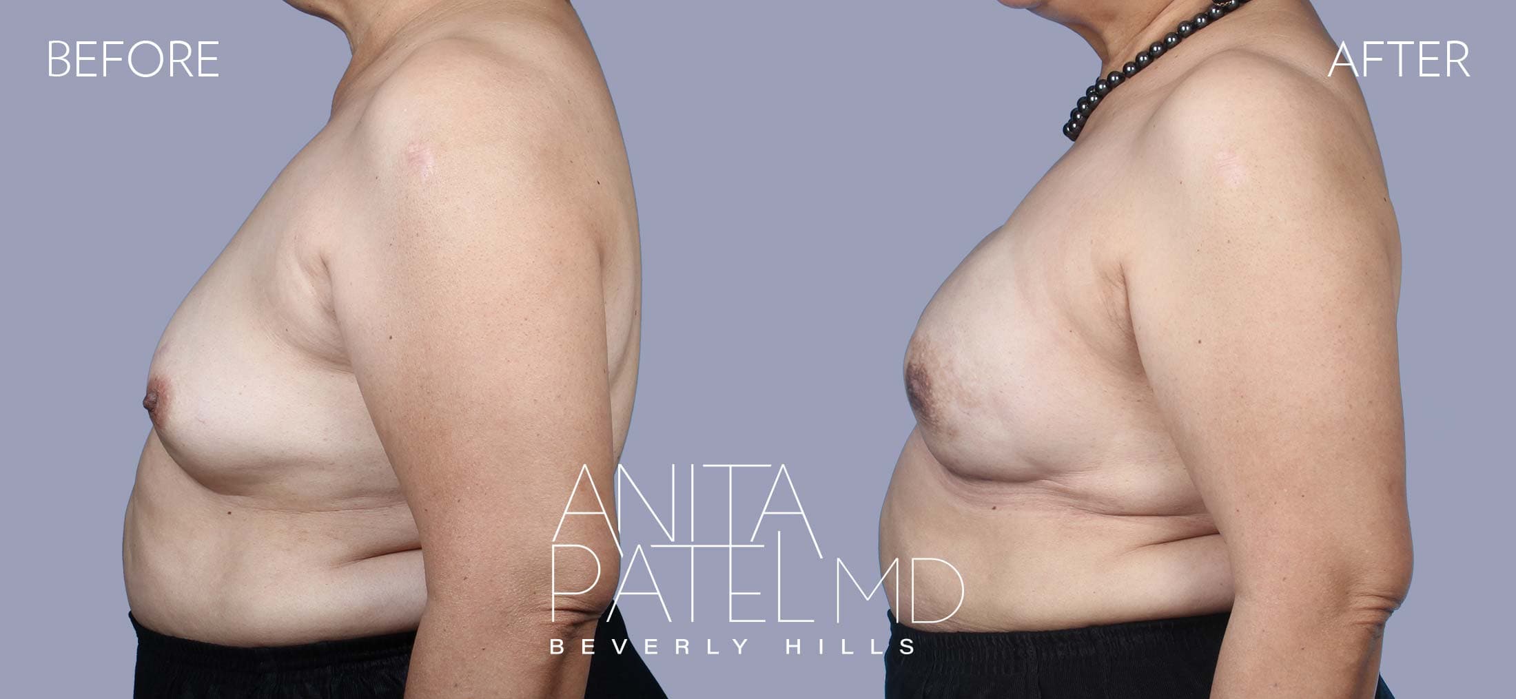 Breast Reconstruction before and after — Patient 3, photo 2 of 2 — Dr. Anita Patel, MD, FACS, Beverly Hills