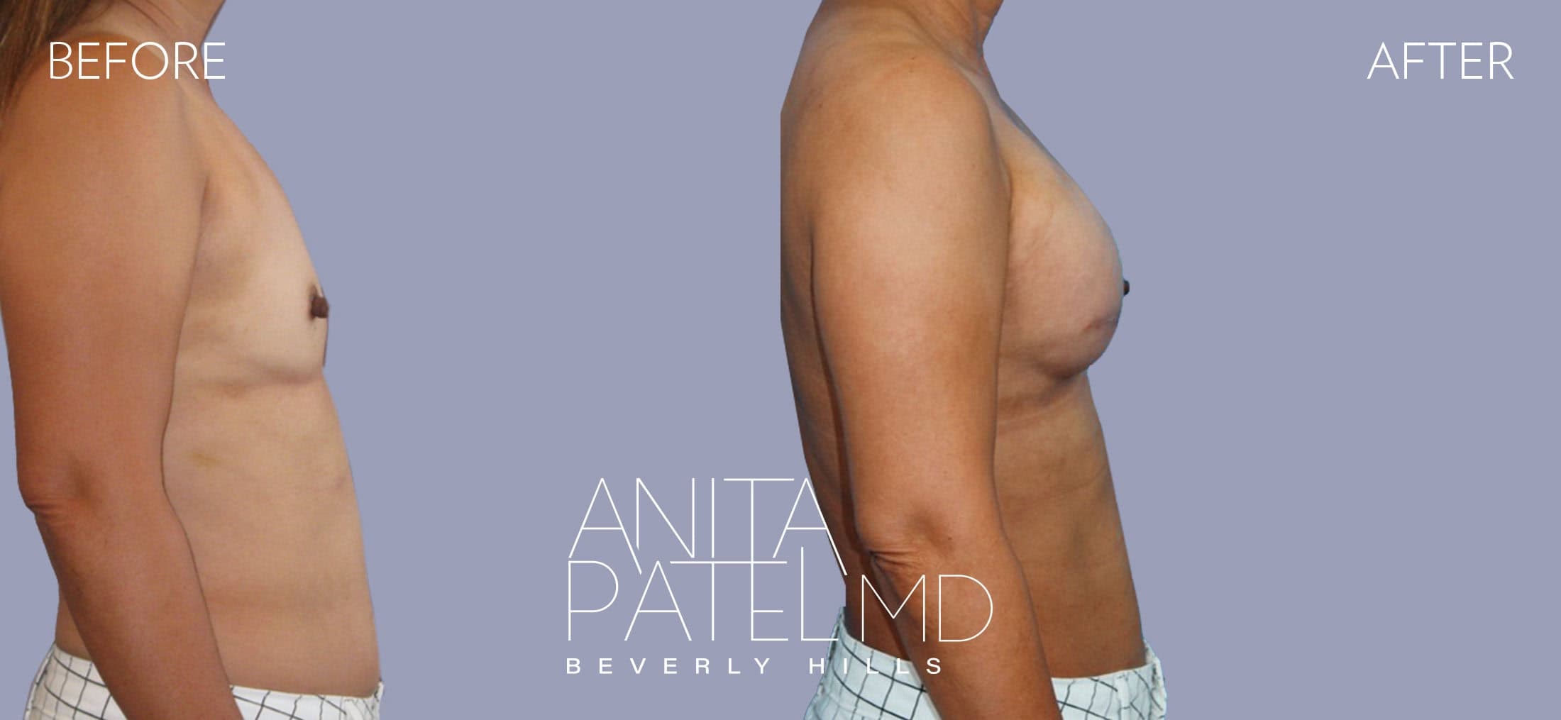 Breast Reconstruction before and after — Patient 7, photo 3 of 5 — Dr. Anita Patel, MD, FACS, Beverly Hills