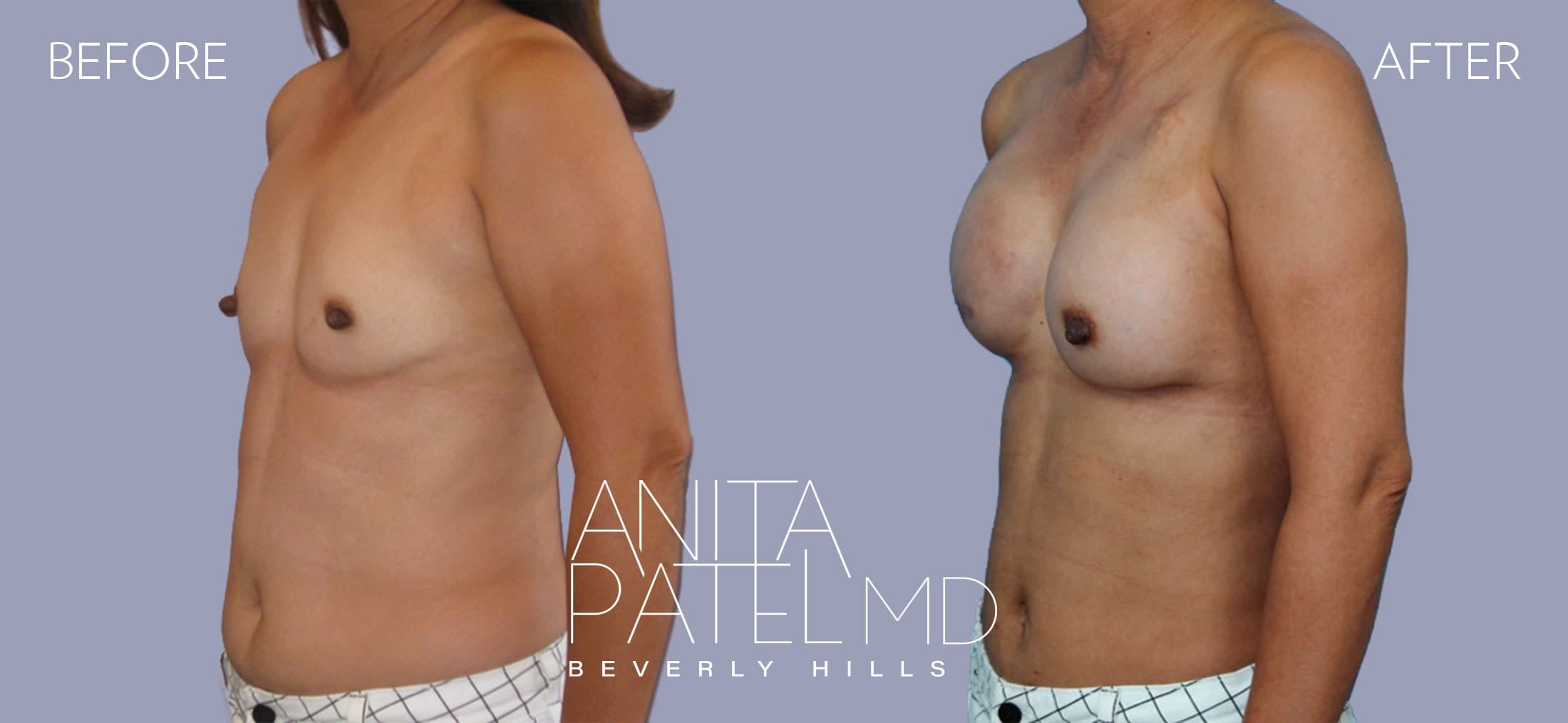 Breast Reconstruction before and after — Patient 7, photo 4 of 5 — Dr. Anita Patel, MD, FACS, Beverly Hills