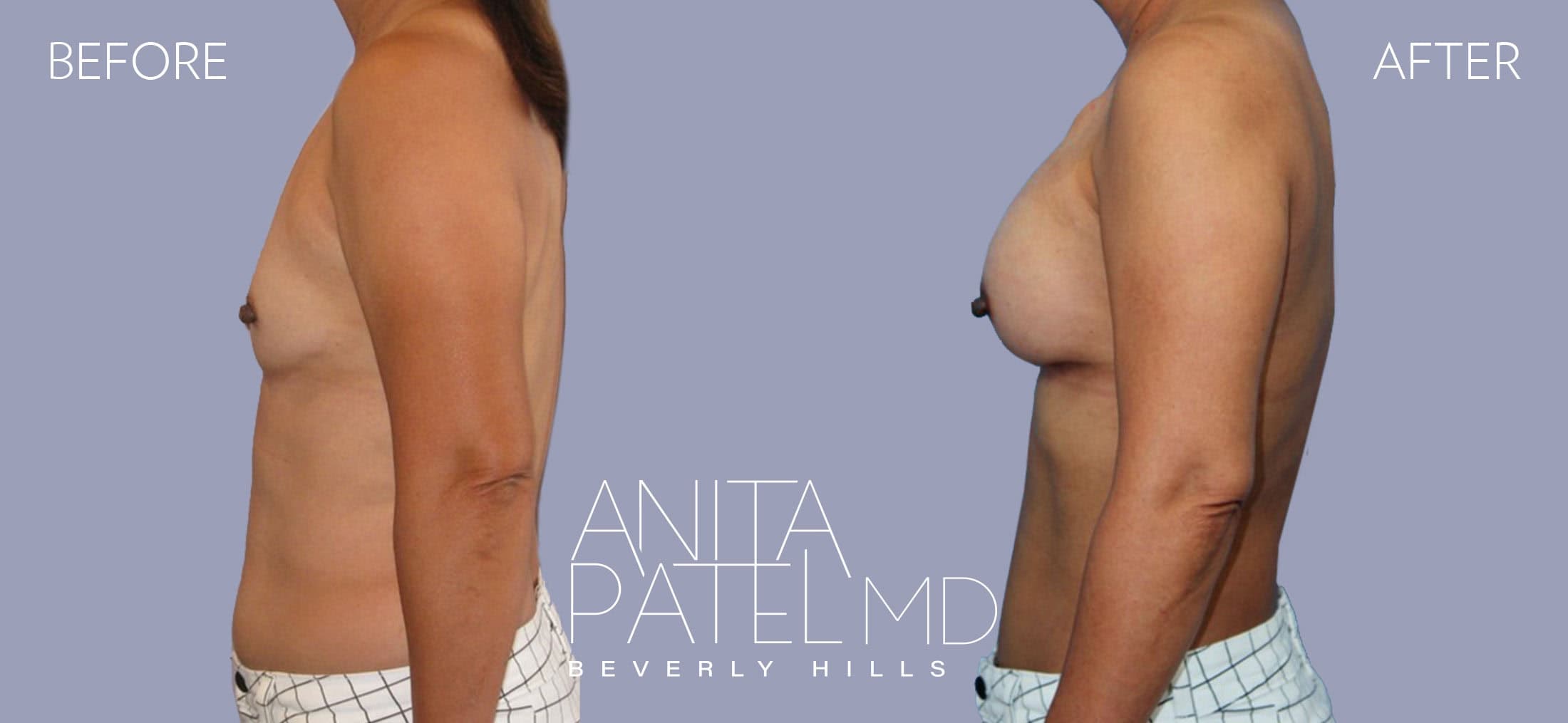 Breast Reconstruction before and after — Patient 7, photo 5 of 5 — Dr. Anita Patel, MD, FACS, Beverly Hills