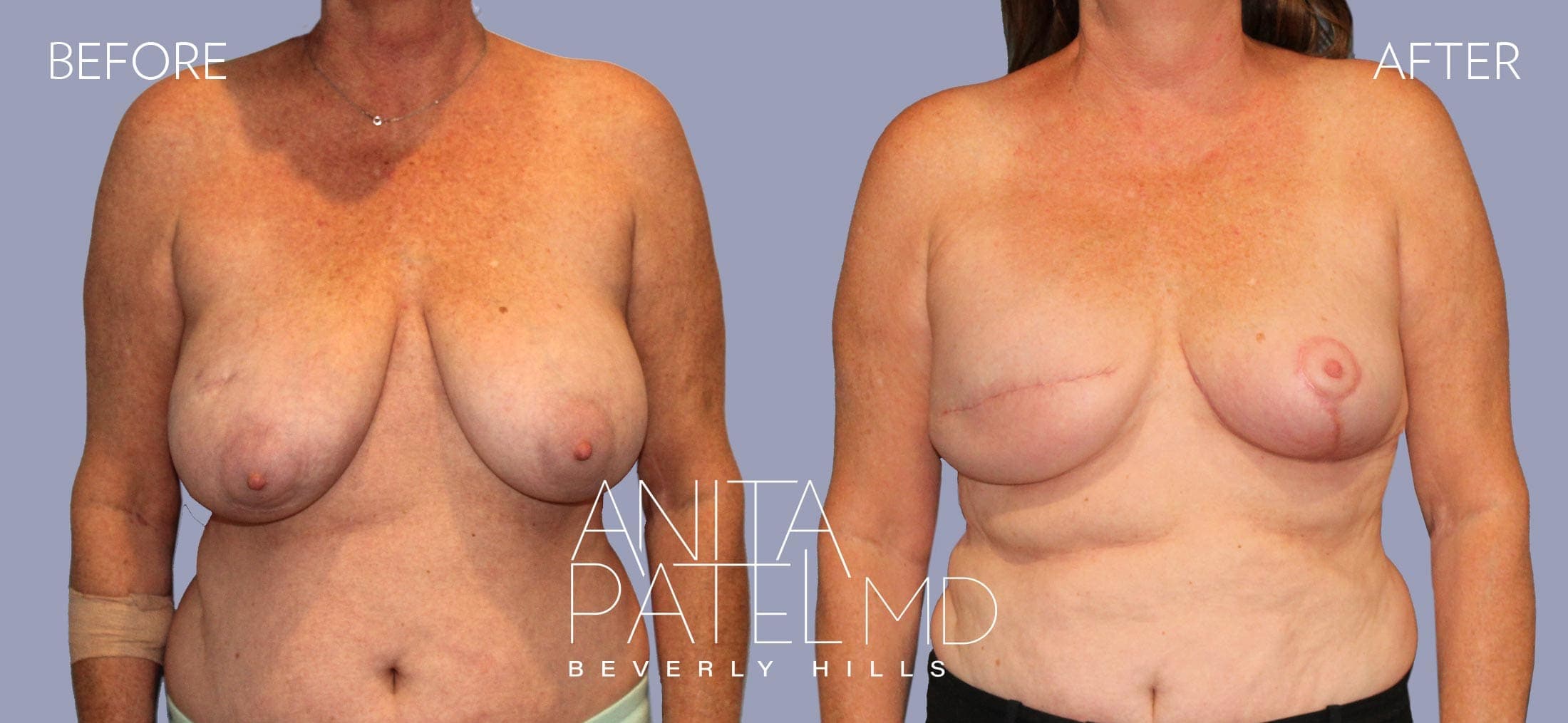 Breast Reconstruction before and after — Patient 4 — Dr. Anita Patel, MD, FACS, Beverly Hills
