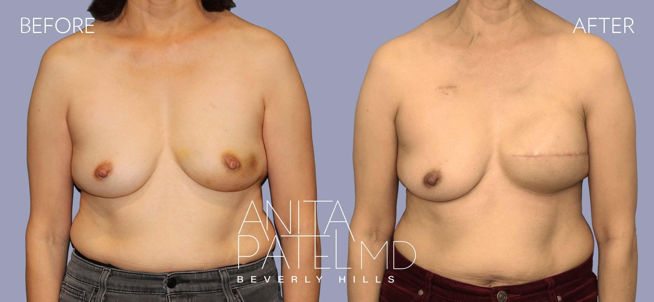 Breast Reconstruction before and after — Patient 6 — Dr. Anita Patel, MD, FACS, Beverly Hills