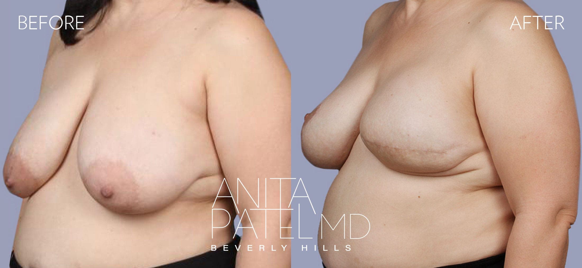 Breast Reconstruction before and after — Patient 1, photo 1 of 2 — Dr. Anita Patel, MD, FACS, Beverly Hills
