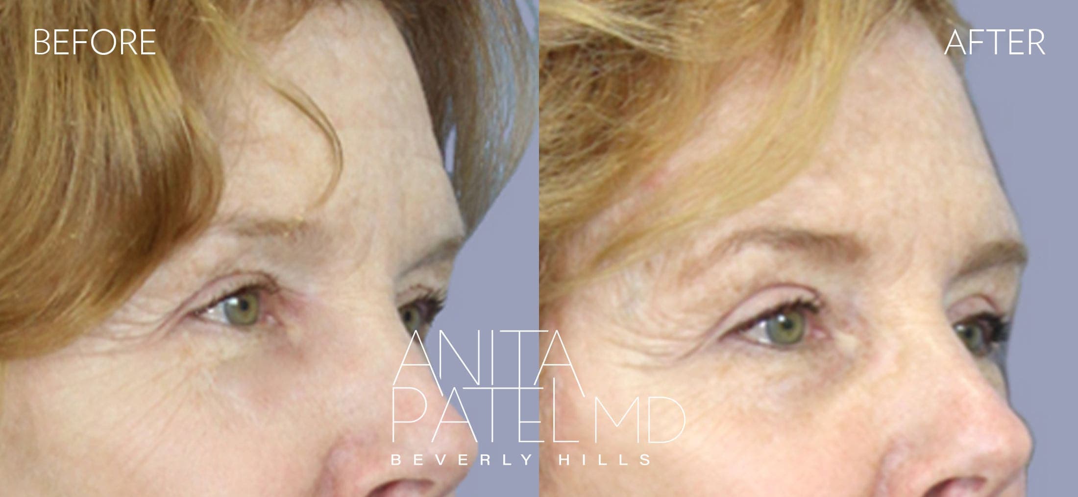 Brow Lift before and after — Patient 1, photo 2 of 5 — Dr. Anita Patel, MD, FACS, Beverly Hills