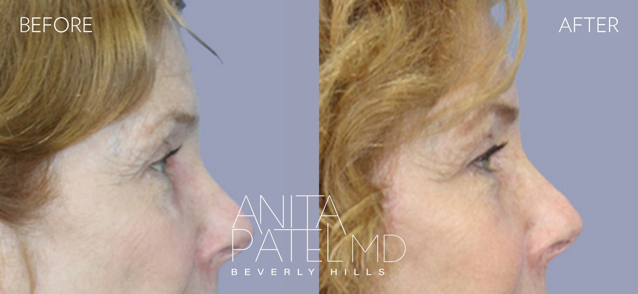 Brow Lift before and after — Patient 1, photo 3 of 5 — Dr. Anita Patel, MD, FACS, Beverly Hills