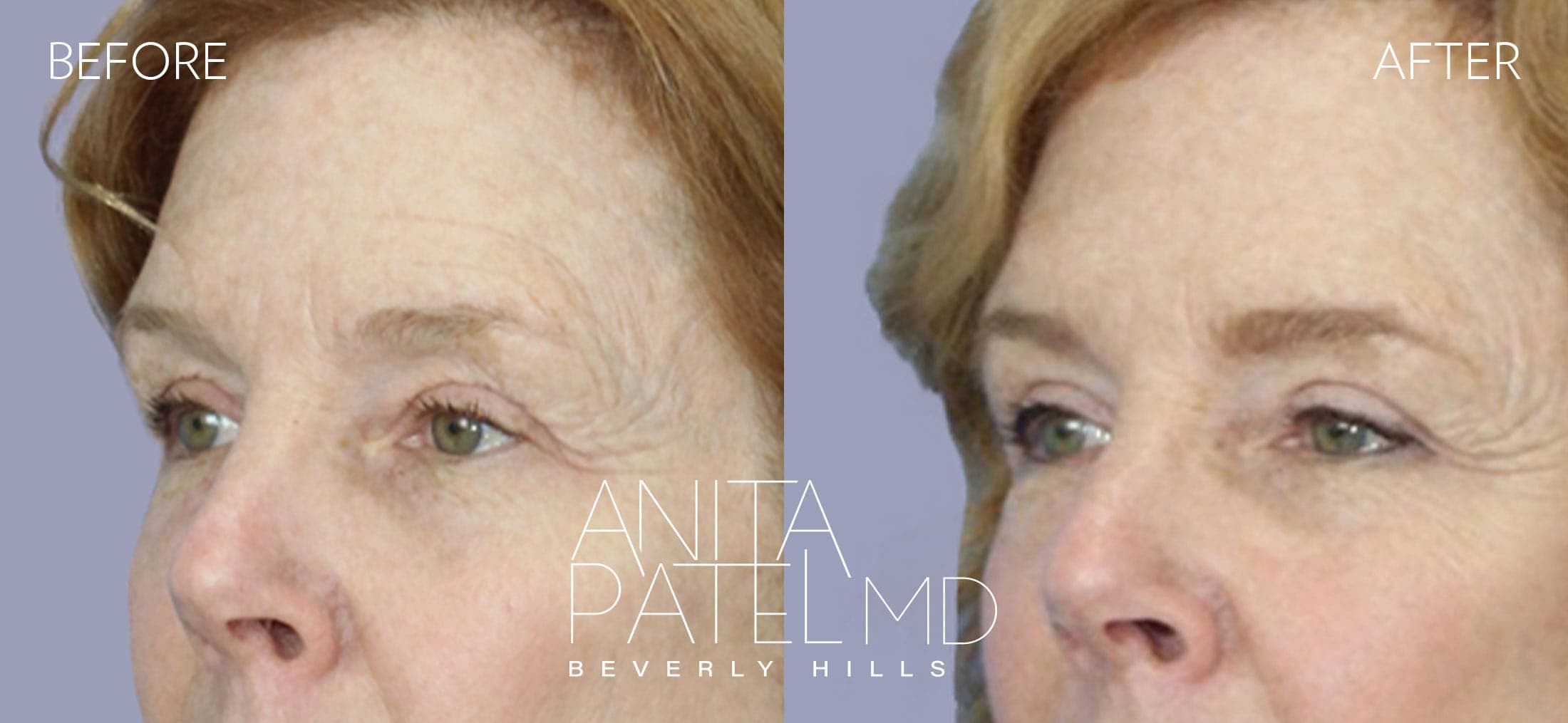 Brow Lift before and after — Patient 1, photo 4 of 5 — Dr. Anita Patel, MD, FACS, Beverly Hills
