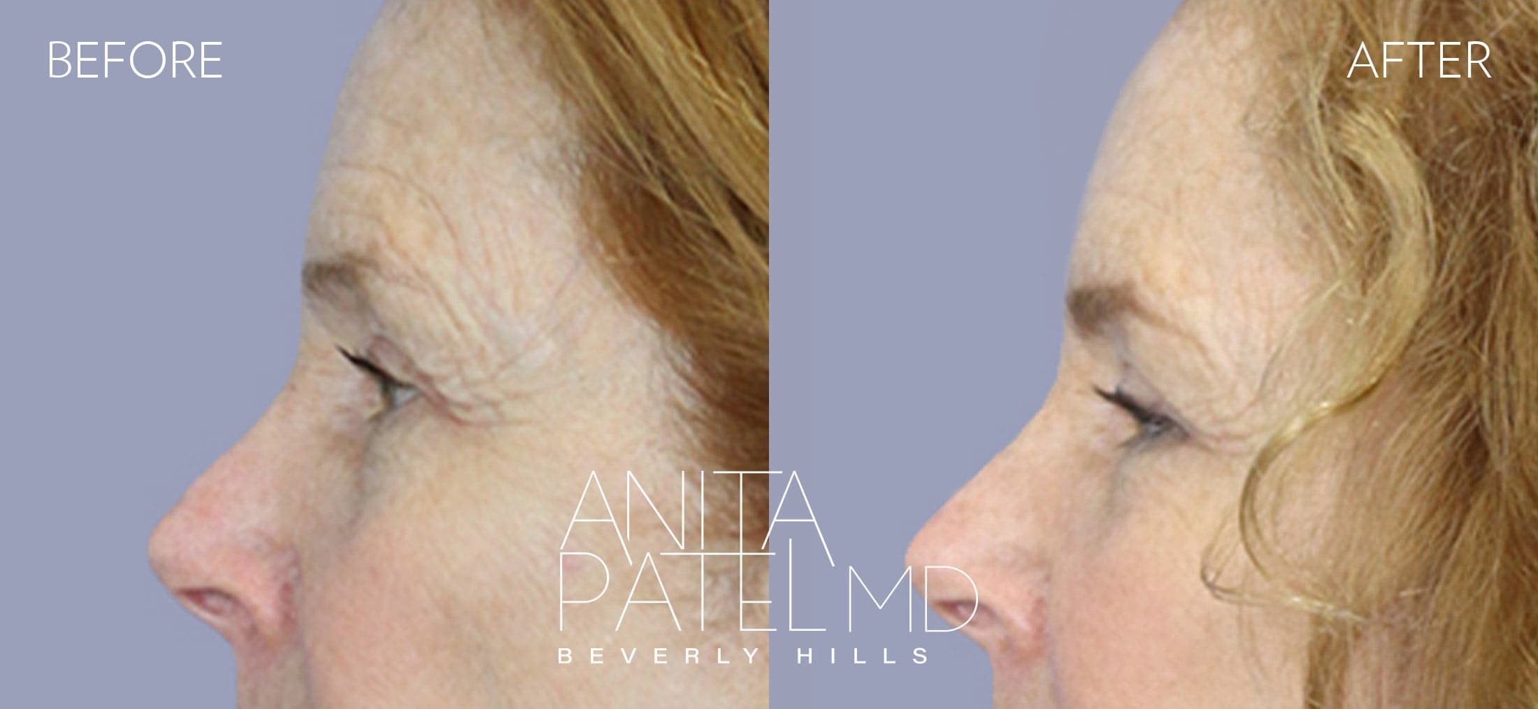 Brow Lift before and after — Patient 1, photo 5 of 5 — Dr. Anita Patel, MD, FACS, Beverly Hills