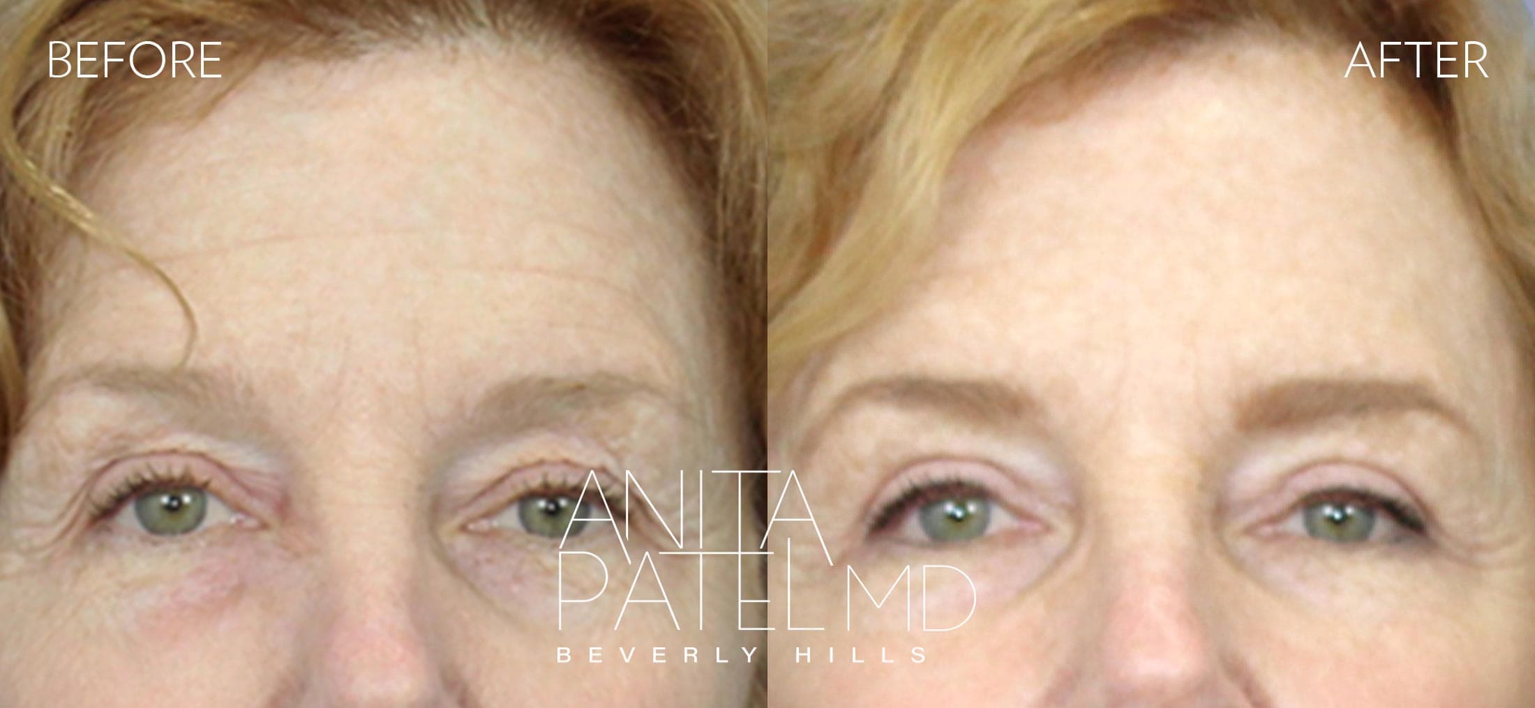 Brow Lift before and after — Dr. Anita Patel, Beverly Hills