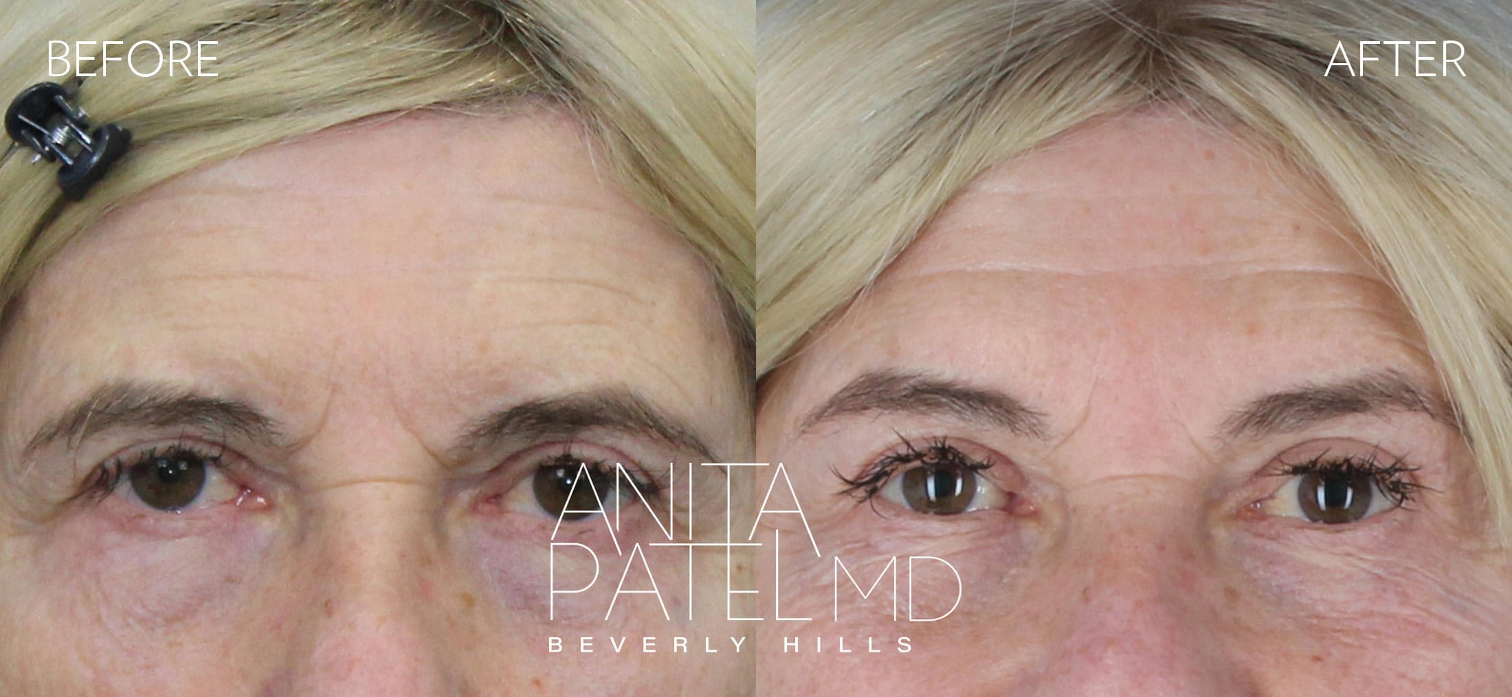 Brow Lift before and after — Patient 2, photo 1 of 5 — Dr. Anita Patel, MD, FACS, Beverly Hills
