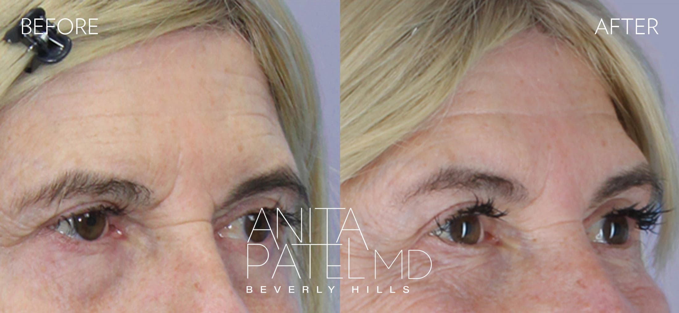 Brow Lift before and after — Patient 2, photo 2 of 5 — Dr. Anita Patel, MD, FACS, Beverly Hills
