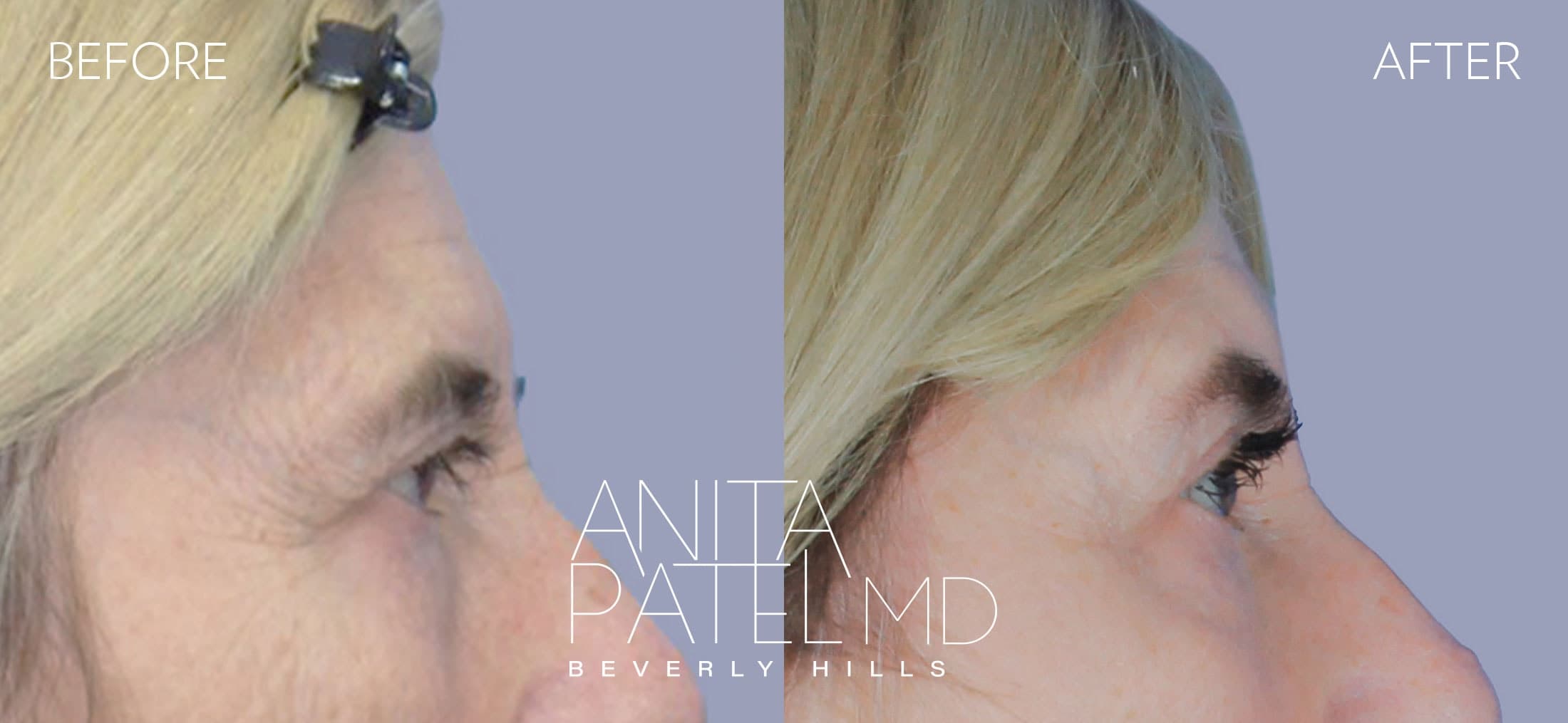Brow Lift before and after — Patient 2, photo 3 of 5 — Dr. Anita Patel, MD, FACS, Beverly Hills