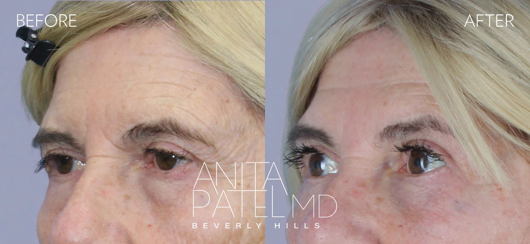 Brow Lift before and after — Patient 2, photo 4 of 5 — Dr. Anita Patel, MD, FACS, Beverly Hills