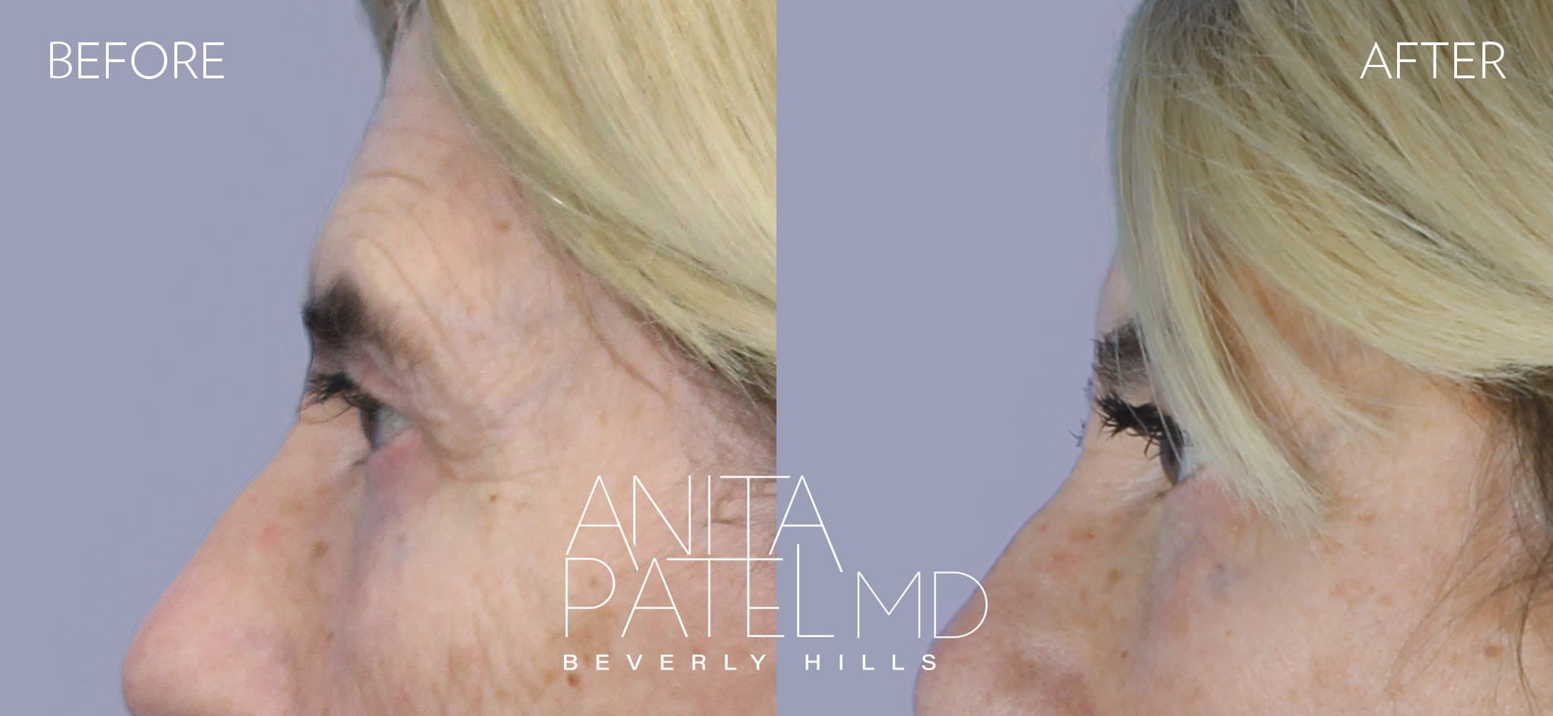 Brow Lift before and after — Patient 2, photo 5 of 5 — Dr. Anita Patel, MD, FACS, Beverly Hills