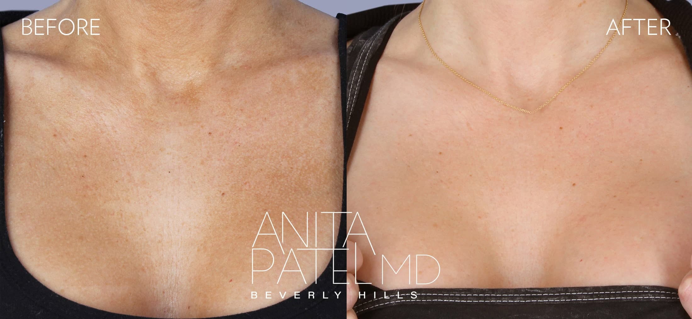 Fractional Laser Aesthetic Treatment before and after — Patient 6 — Dr. Anita Patel, MD, FACS, Beverly Hills