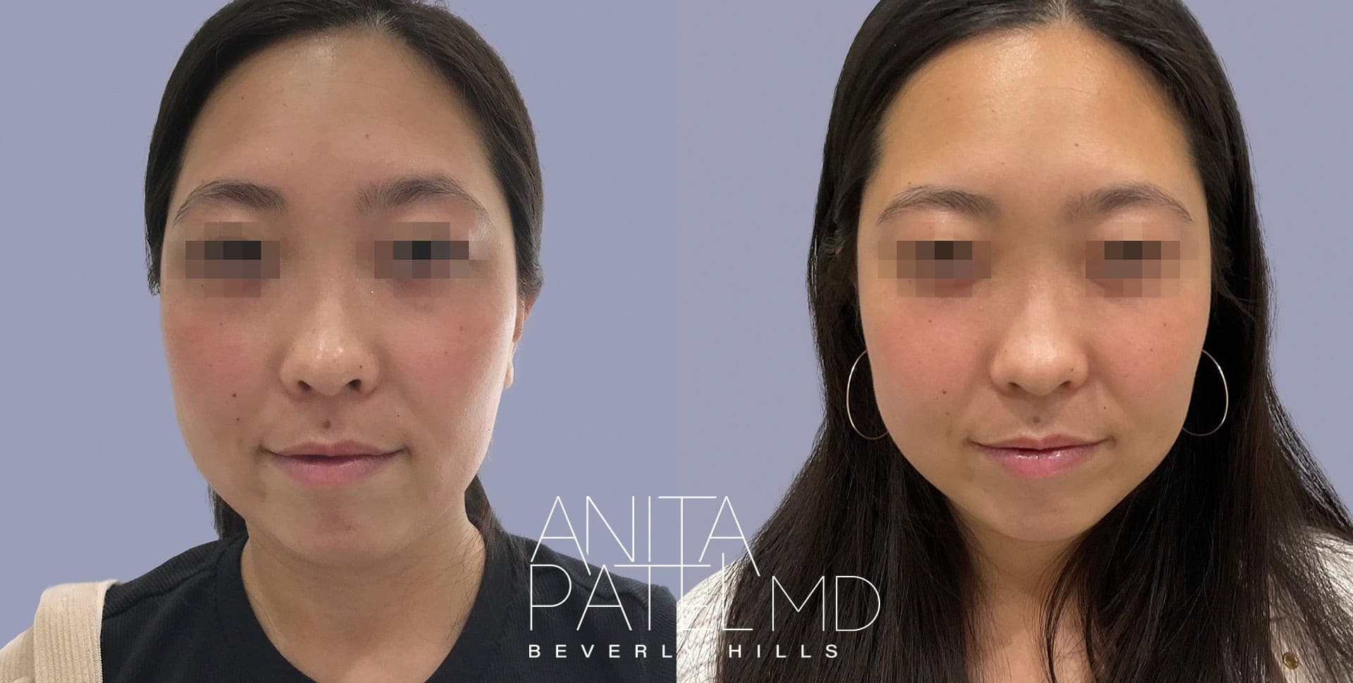Liquid Makeover® before and after — Patient 4 — Dr. Anita Patel, MD, FACS, Beverly Hills