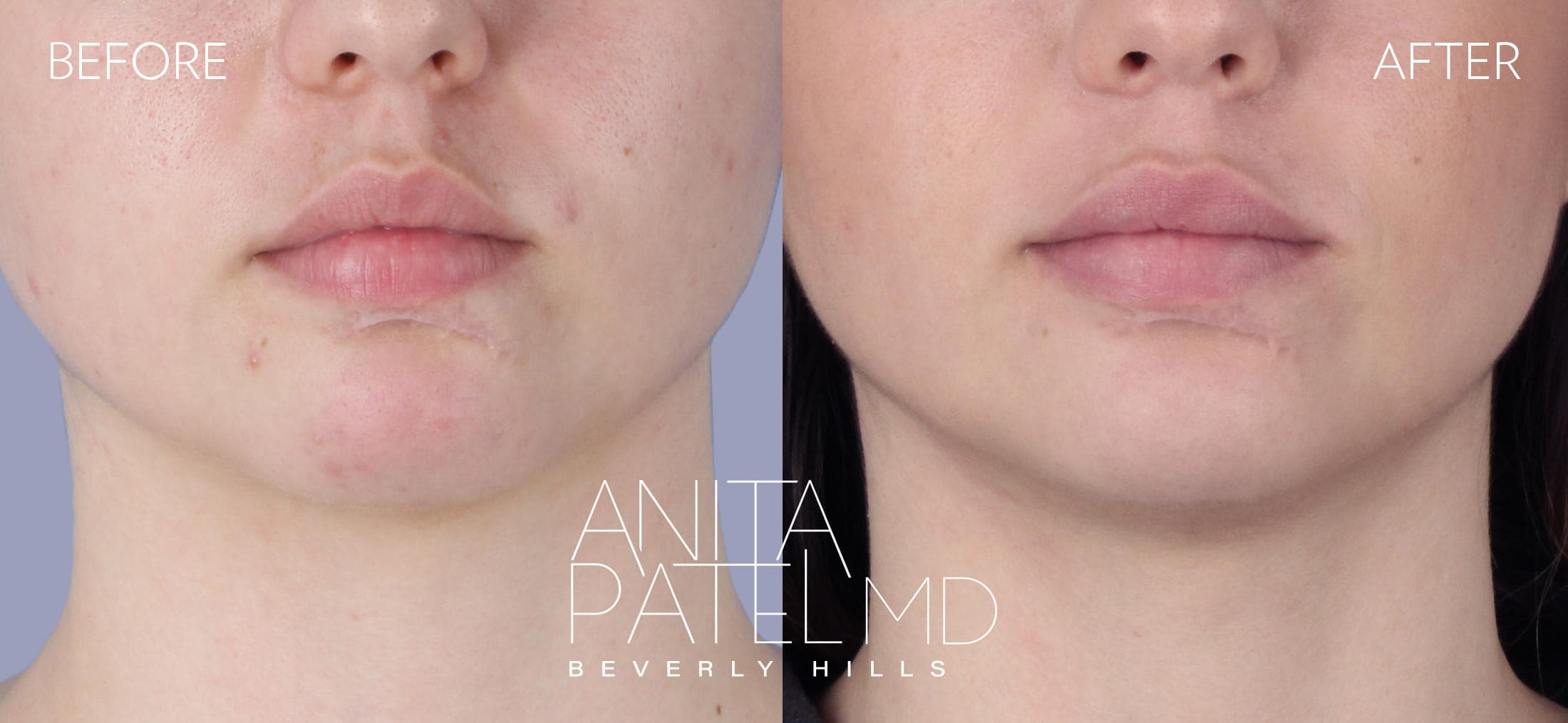 Fractional Laser Aesthetic Treatment before and after — Patient 8 — Dr. Anita Patel, MD, FACS, Beverly Hills