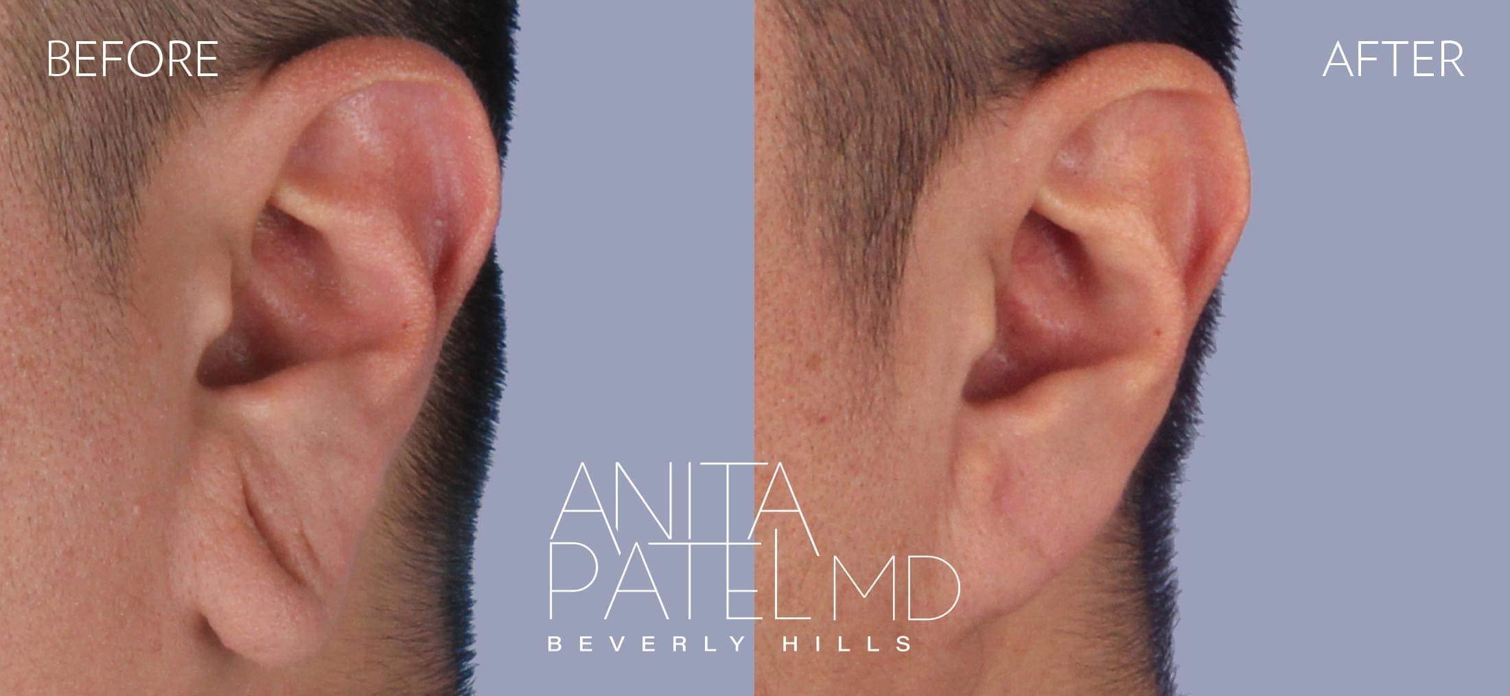 Earlobe Repair before and after — Patient 3, photo 1 of 2 — Dr. Anita Patel, MD, FACS, Beverly Hills