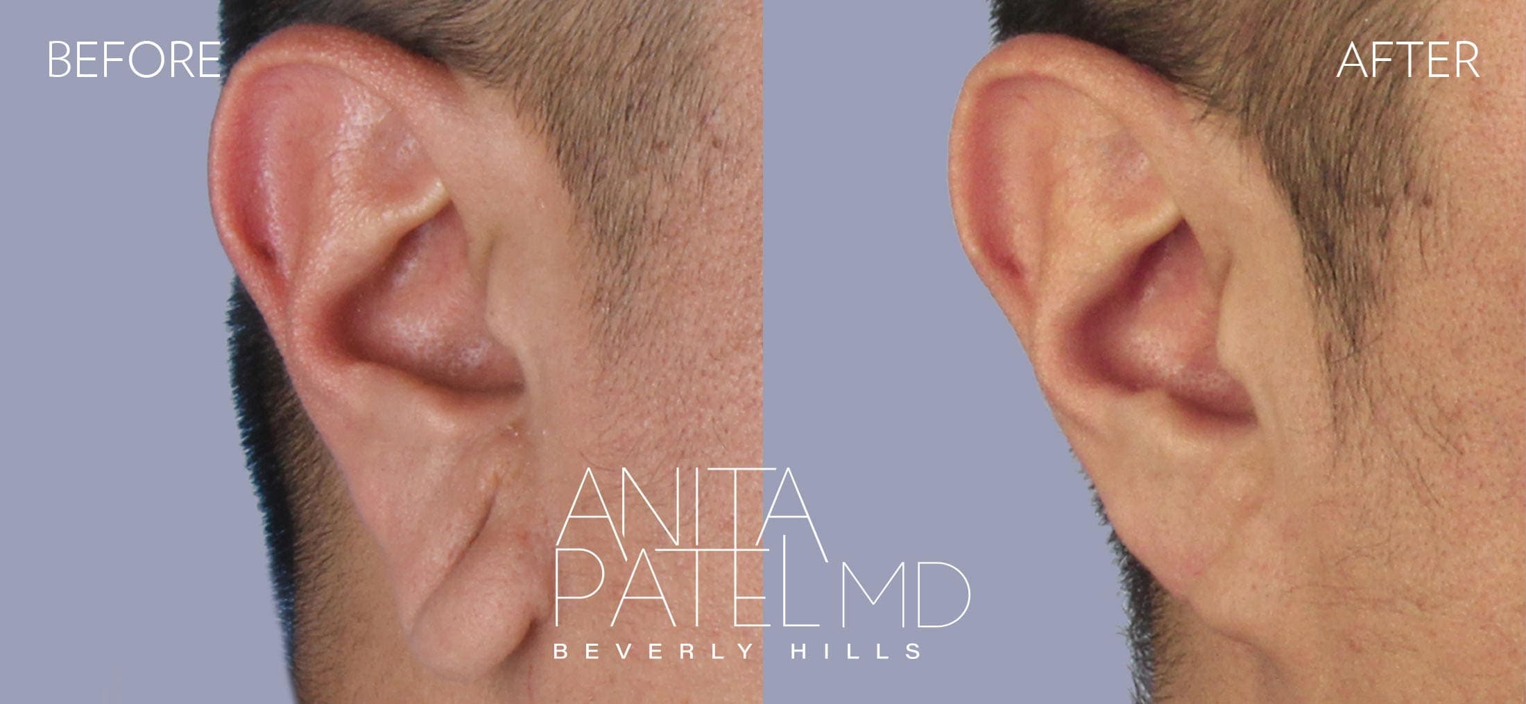 Earlobe Repair before and after — Patient 3, photo 2 of 2 — Dr. Anita Patel, MD, FACS, Beverly Hills
