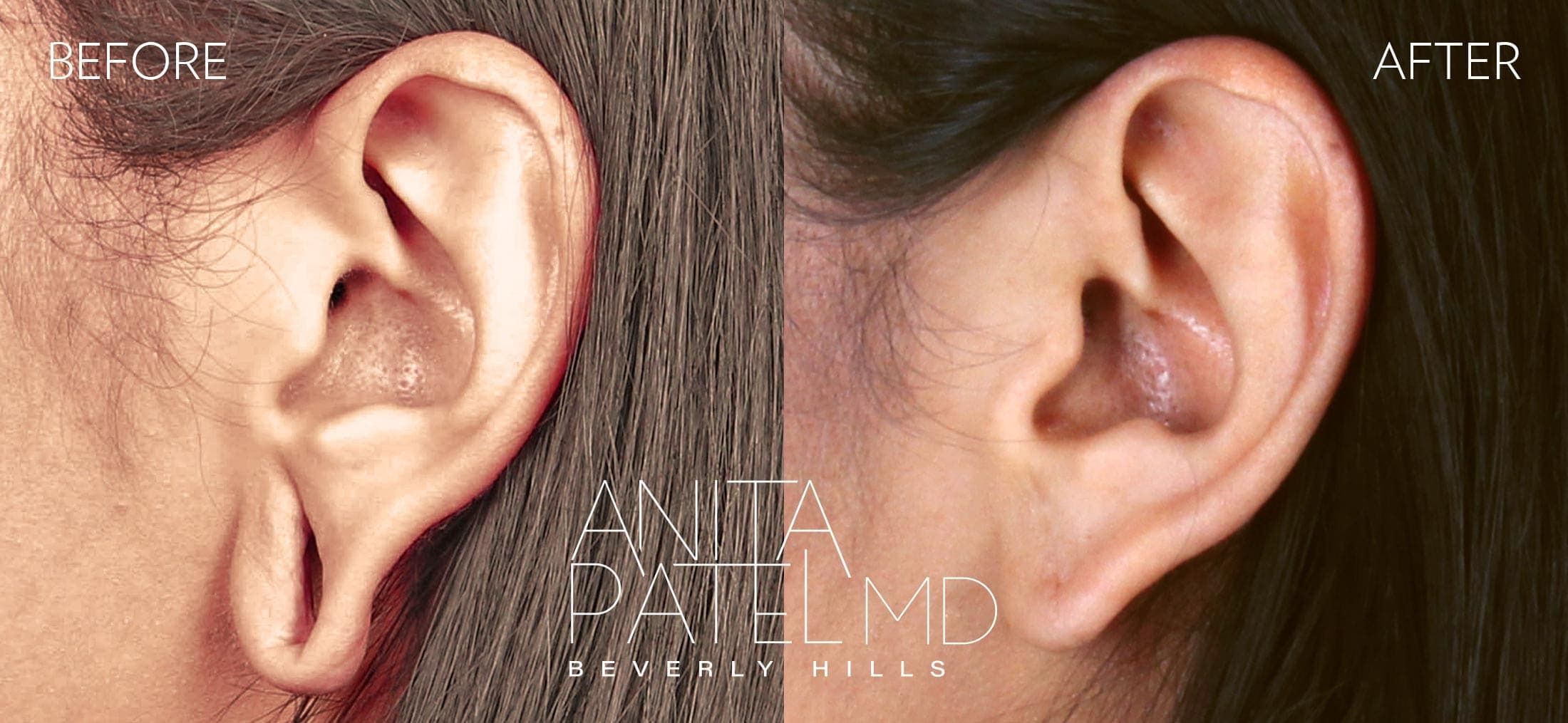 Earlobe Repair before and after — Patient 2, photo 2 of 2 — Dr. Anita Patel, MD, FACS, Beverly Hills