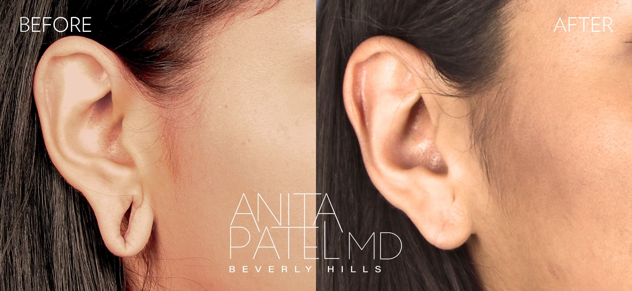 Earlobe Repair before and after — Dr. Anita Patel, Beverly Hills