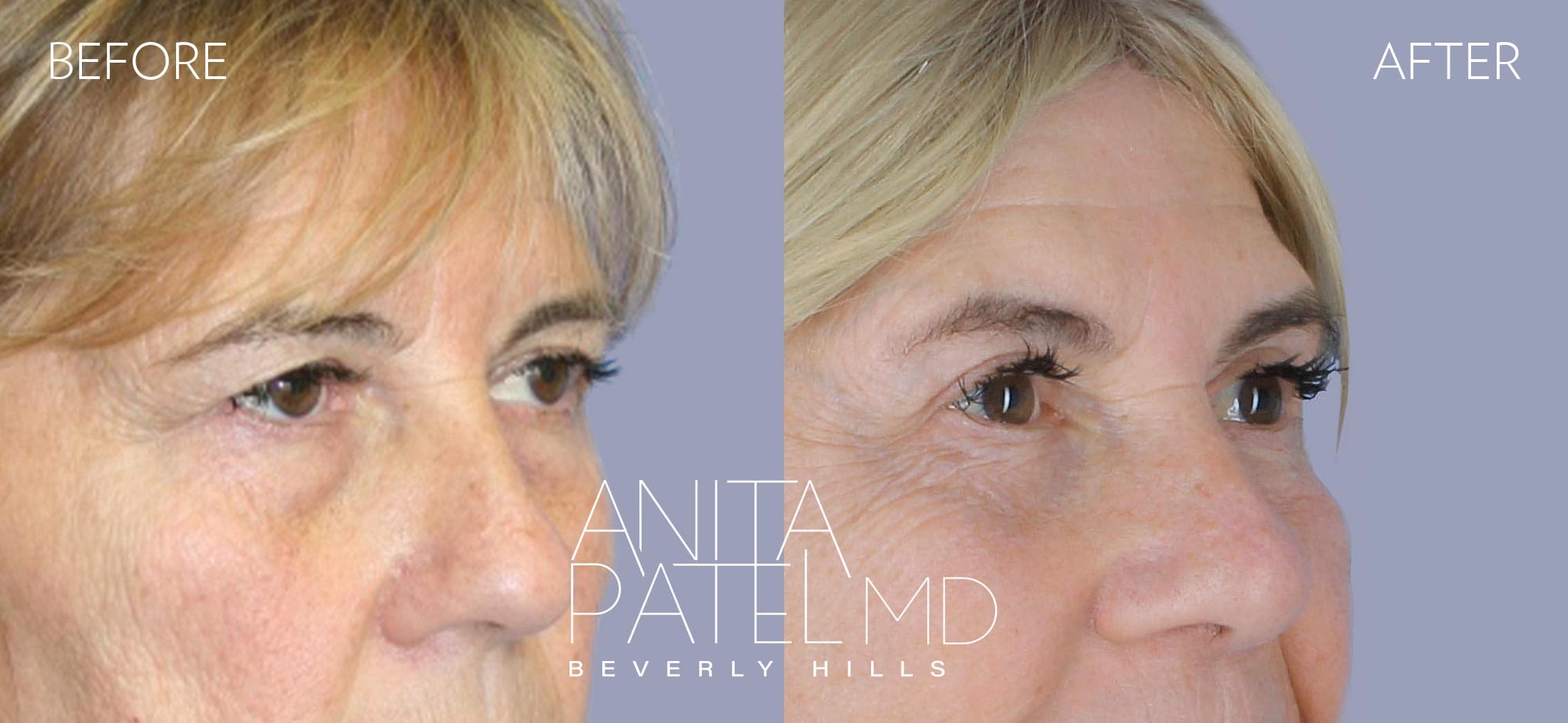Eyelid Lift before and after — Patient 4, photo 2 of 2 — Dr. Anita Patel, MD, FACS, Beverly Hills