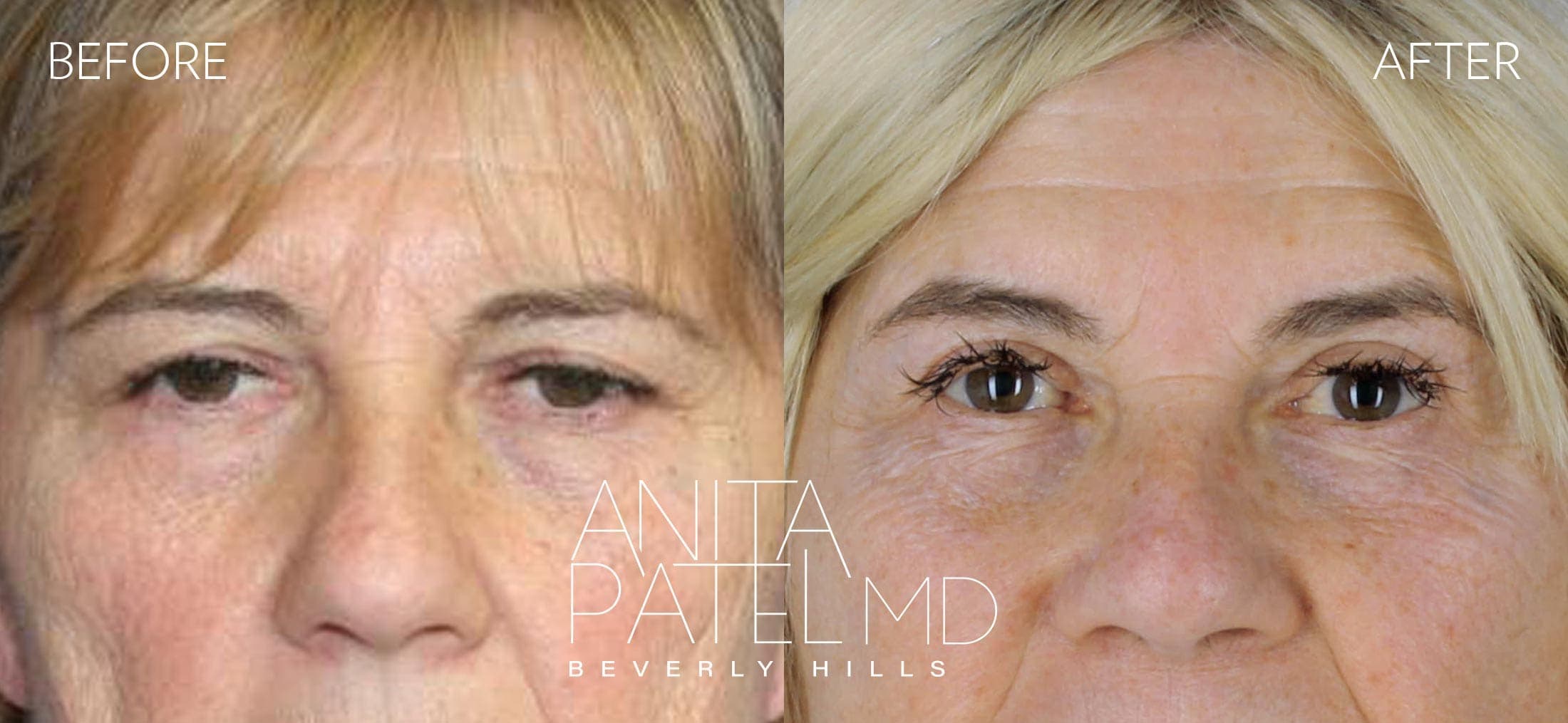 Eyelid Lift before and after — Patient 4, photo 1 of 2 — Dr. Anita Patel, MD, FACS, Beverly Hills