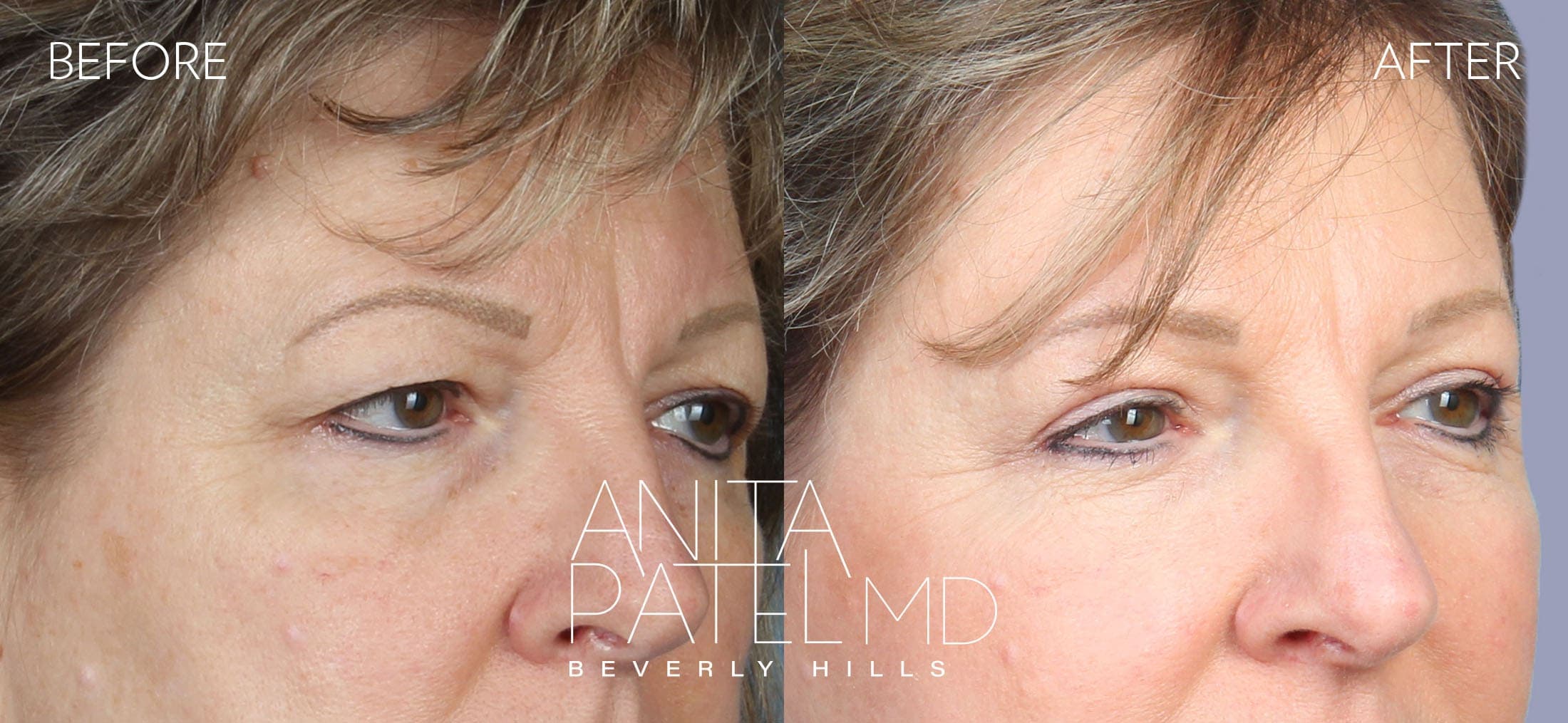 Eyelid Lift before and after — Patient 3 — Dr. Anita Patel, MD, FACS, Beverly Hills