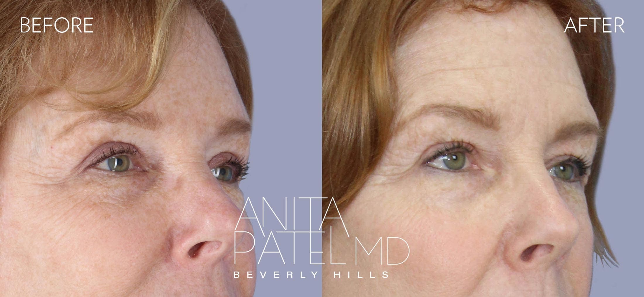 Eyelid Lift before and after — Patient 1, photo 2 of 2 — Dr. Anita Patel, MD, FACS, Beverly Hills