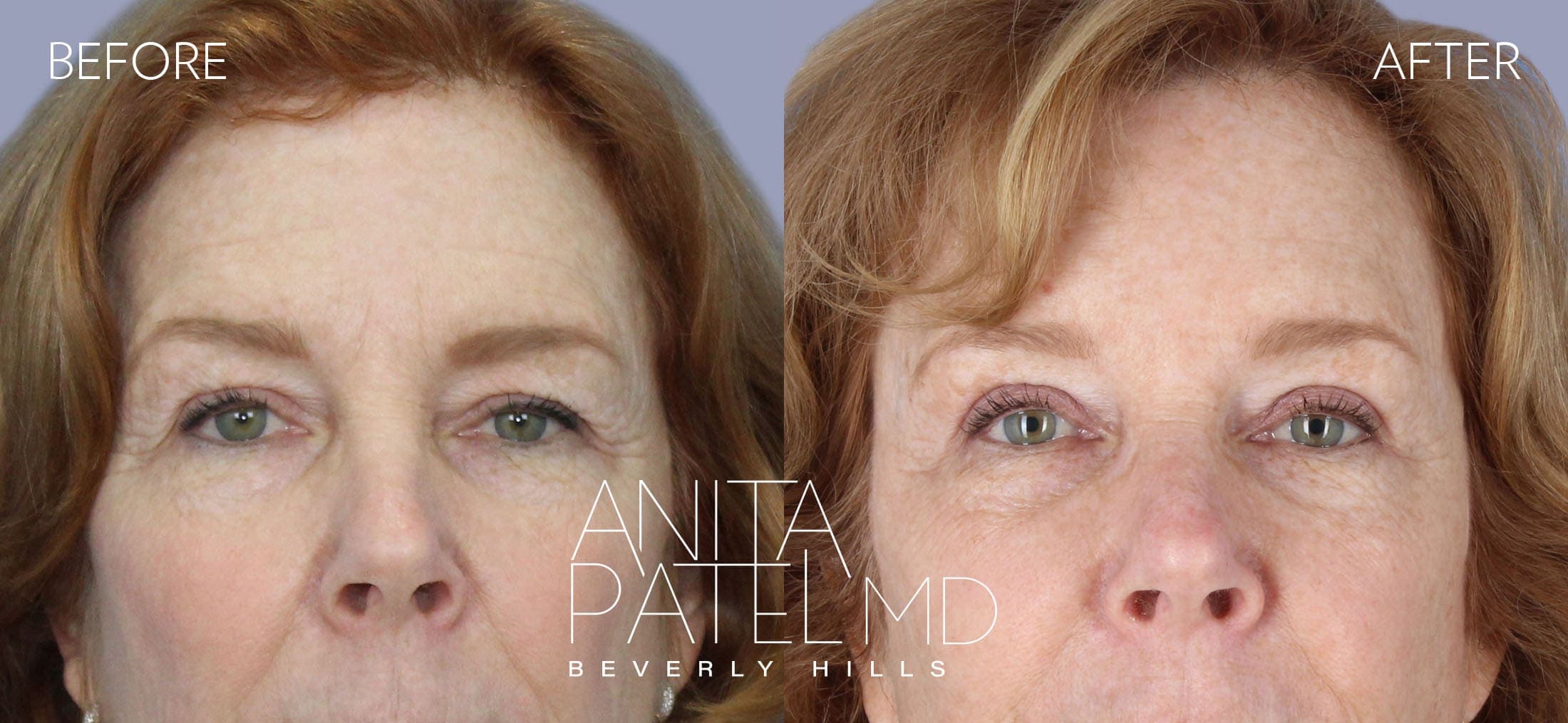 Eyelid Lift before and after — Dr. Anita Patel, Beverly Hills
