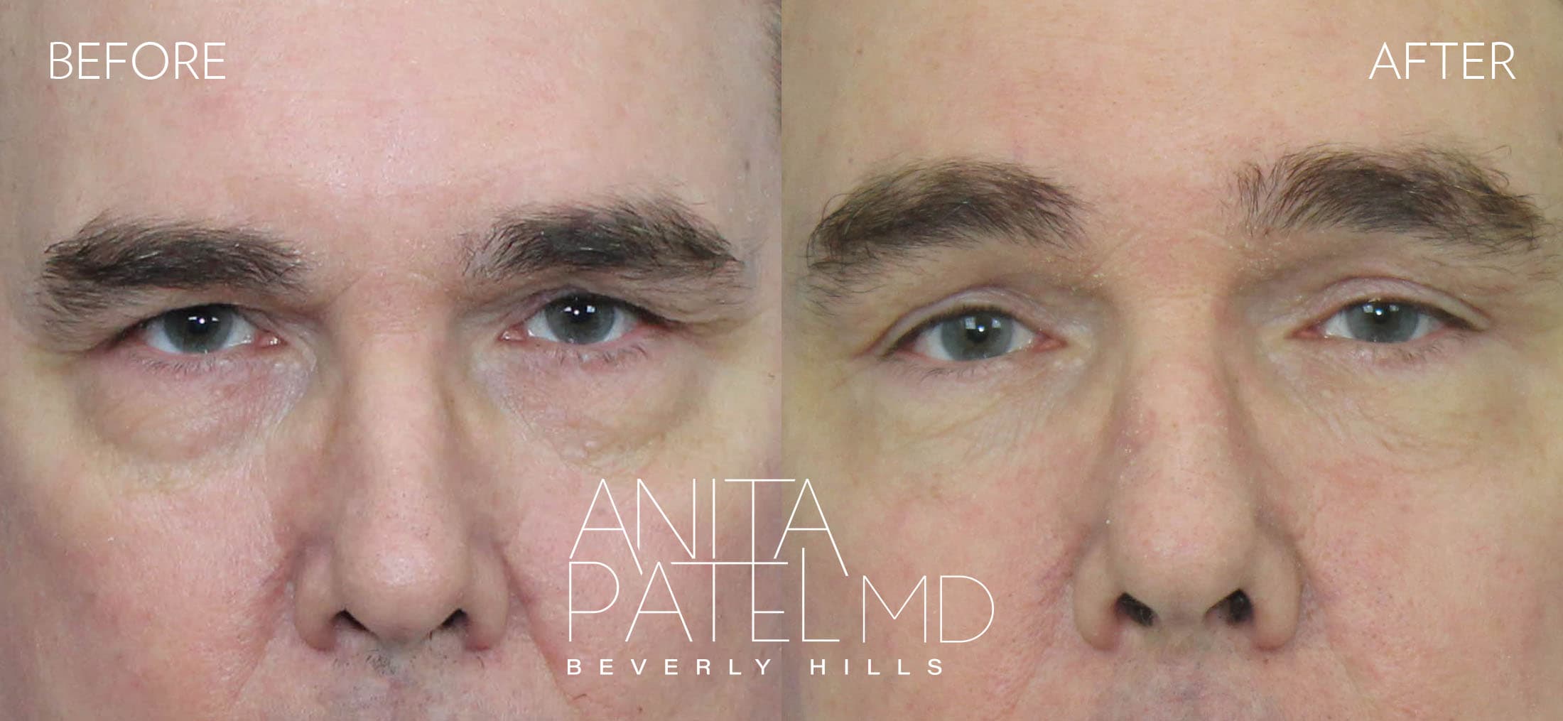 Eyelid Lift before and after — Patient 2 — Dr. Anita Patel, MD, FACS, Beverly Hills