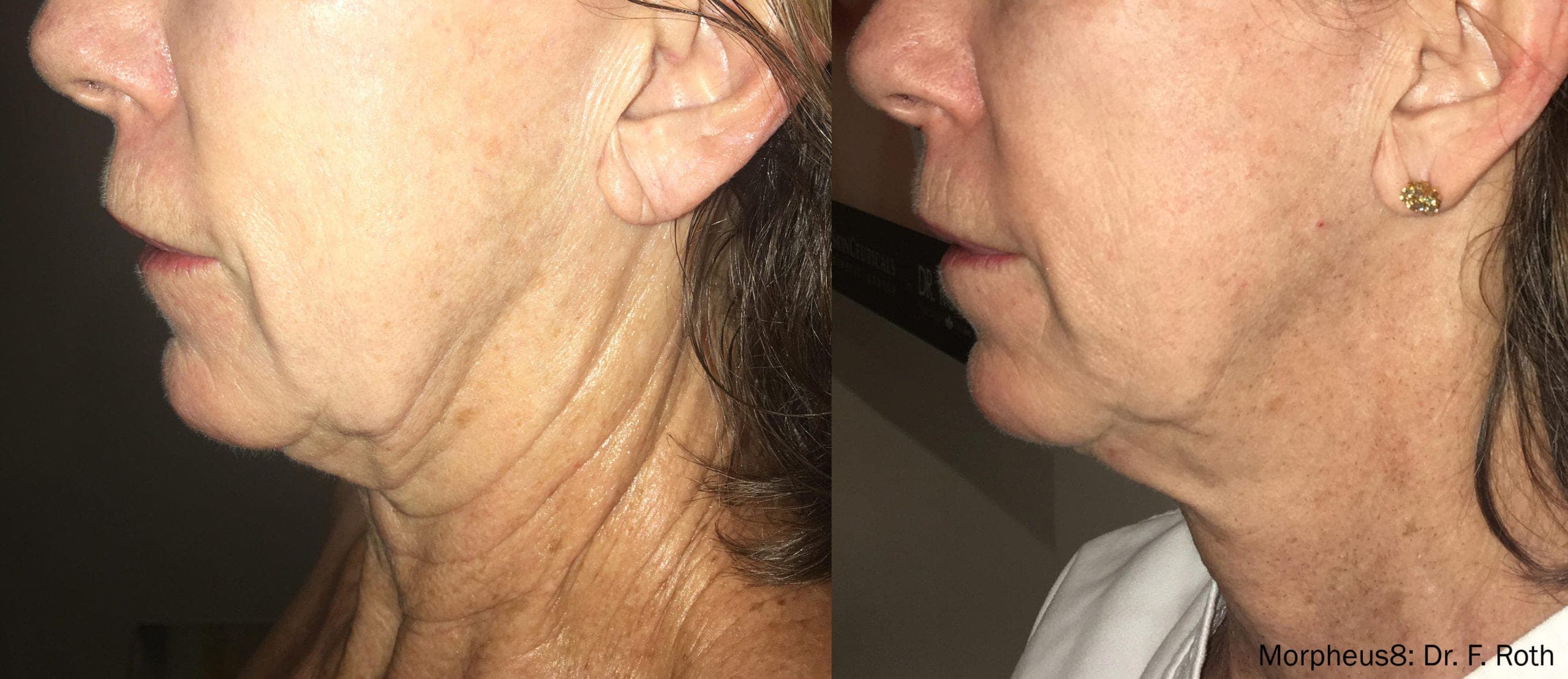 Morpheus8 RF Microneedling before and after — Patient 13 — Dr. Anita Patel, MD, FACS, Beverly Hills