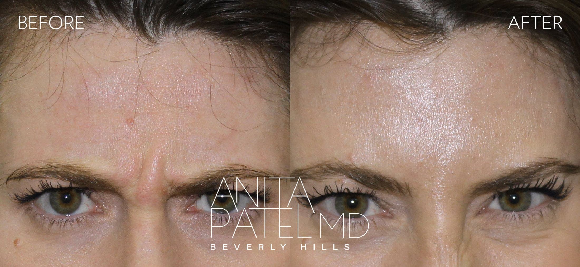Neurotoxin before and after — Patient 3, photo 2 of 2 — Dr. Anita Patel, MD, FACS, Beverly Hills