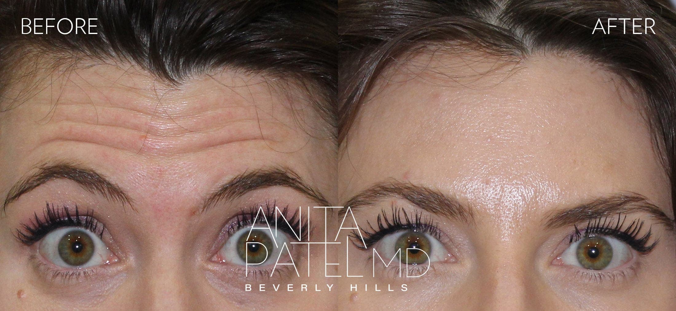 Neurotoxin before and after — Patient 3, photo 1 of 2 — Dr. Anita Patel, MD, FACS, Beverly Hills