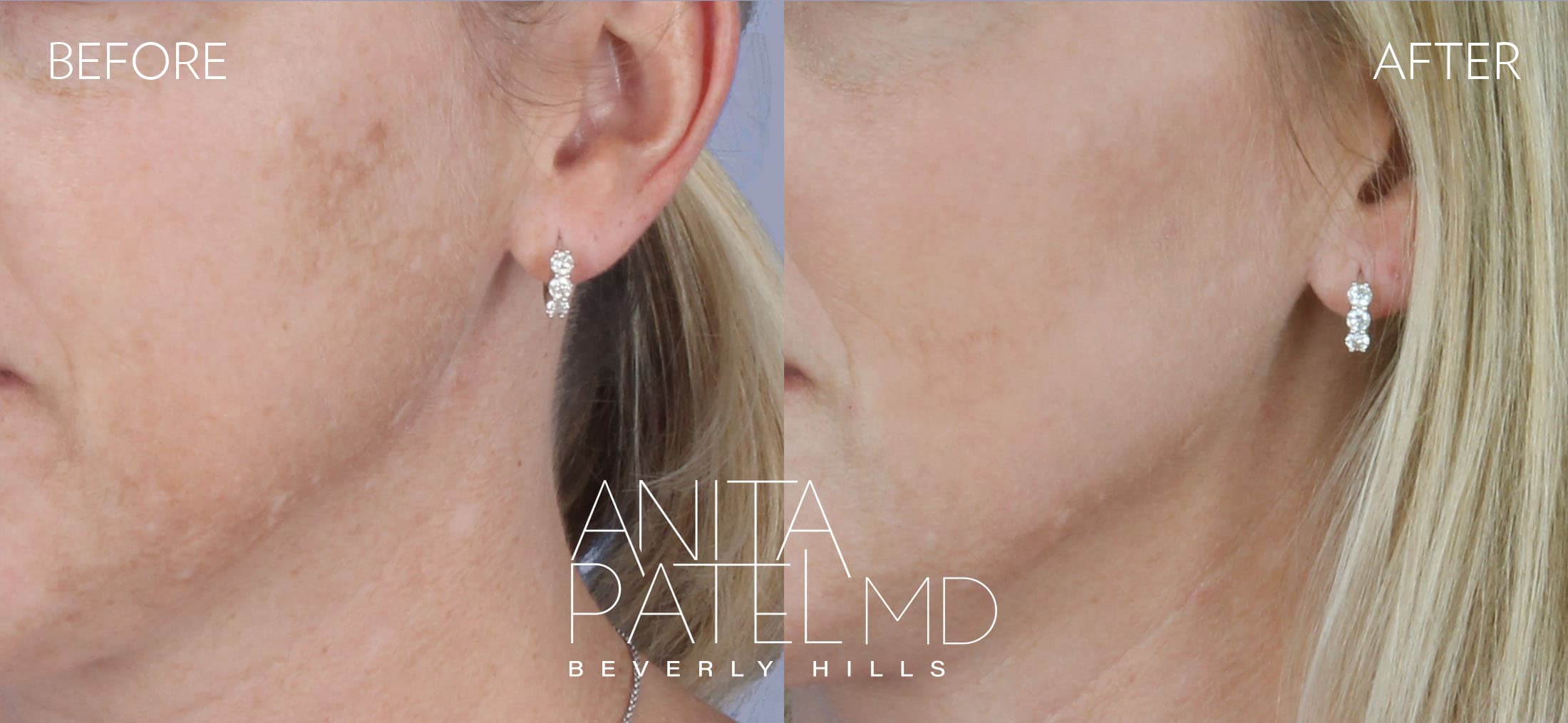 IPL Photofacial before and after — Patient 2 — Dr. Anita Patel, MD, FACS, Beverly Hills
