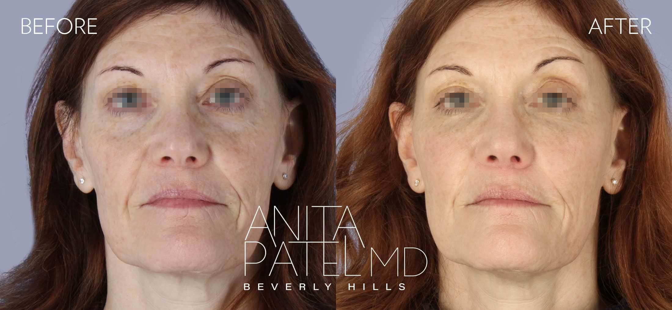 IPL Photofacial before and after — Patient 3, photo 1 of 5 — Dr. Anita Patel, MD, FACS, Beverly Hills