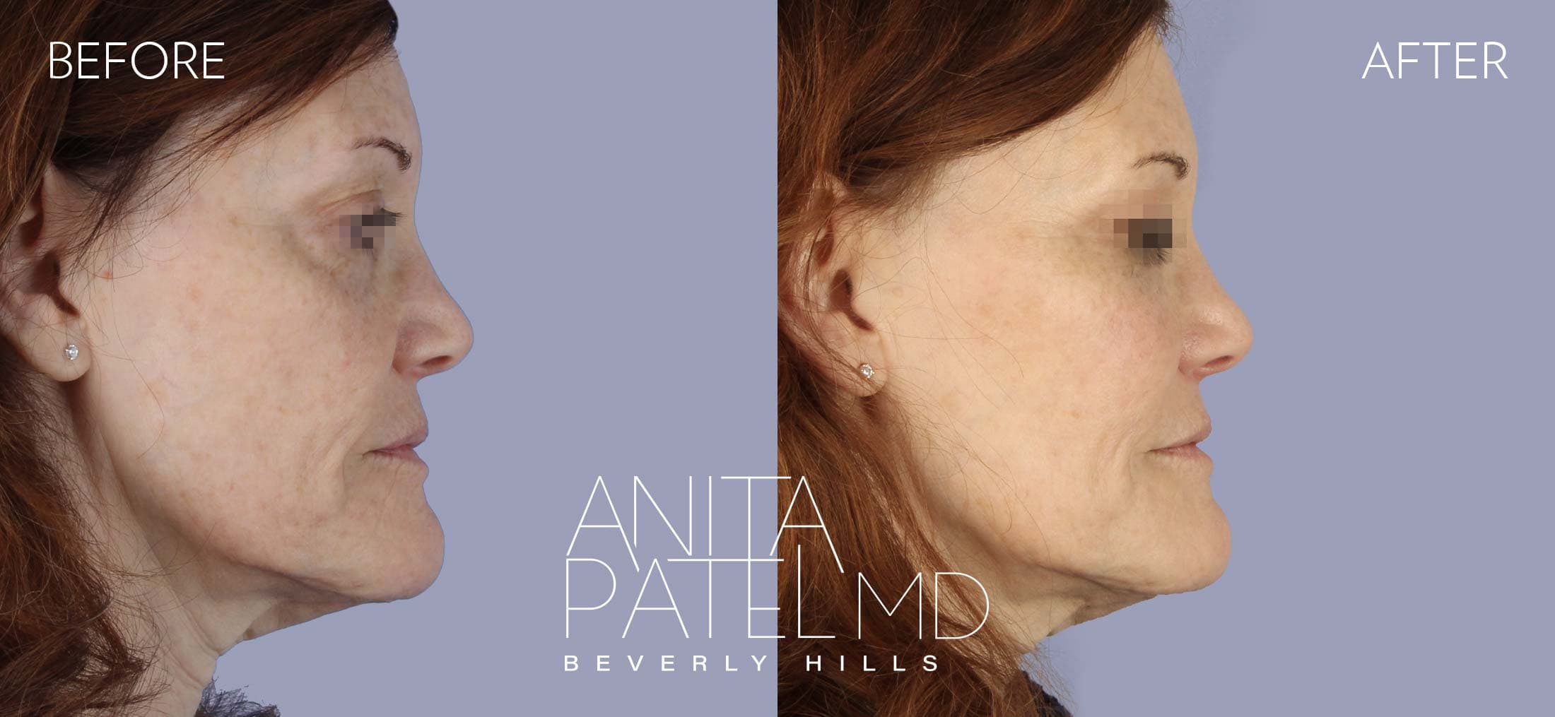 IPL Photofacial before and after — Patient 3, photo 3 of 5 — Dr. Anita Patel, MD, FACS, Beverly Hills