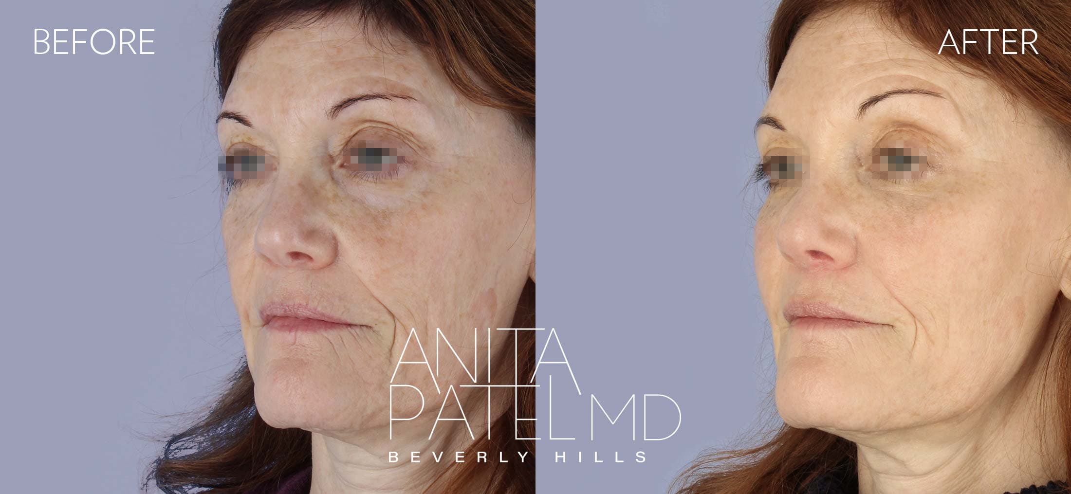 IPL Photofacial before and after — Patient 3, photo 4 of 5 — Dr. Anita Patel, MD, FACS, Beverly Hills