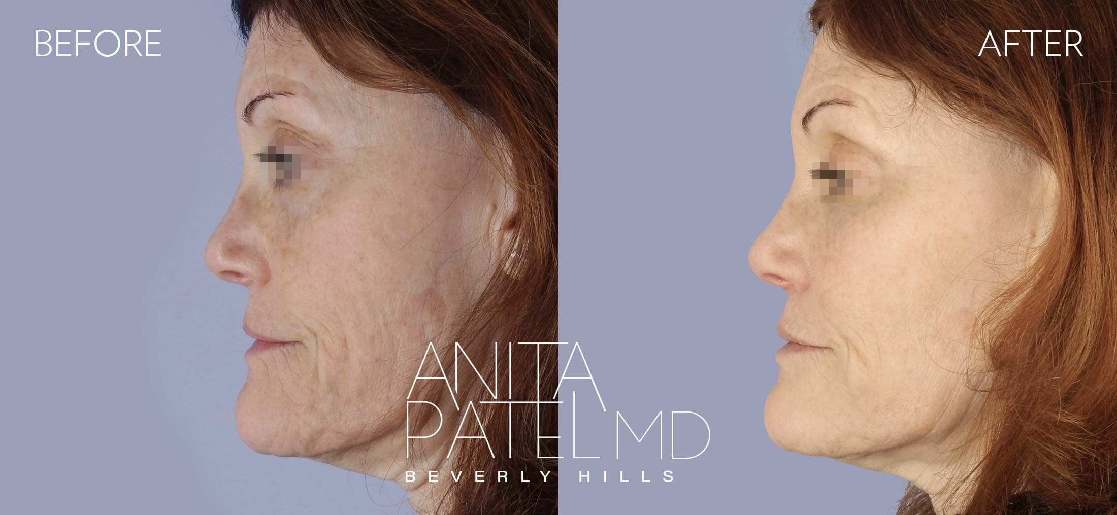 IPL Photofacial before and after — Patient 3, photo 5 of 5 — Dr. Anita Patel, MD, FACS, Beverly Hills