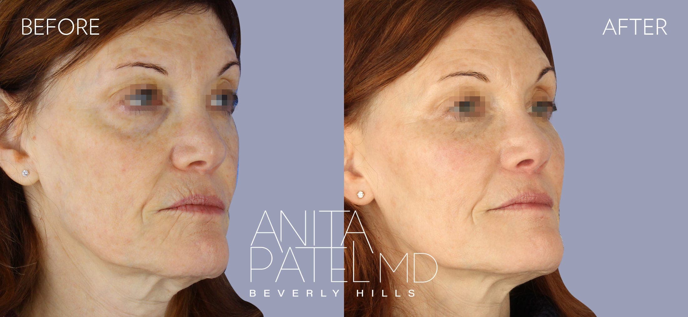 IPL Photofacial before and after — Patient 3, photo 2 of 5 — Dr. Anita Patel, MD, FACS, Beverly Hills