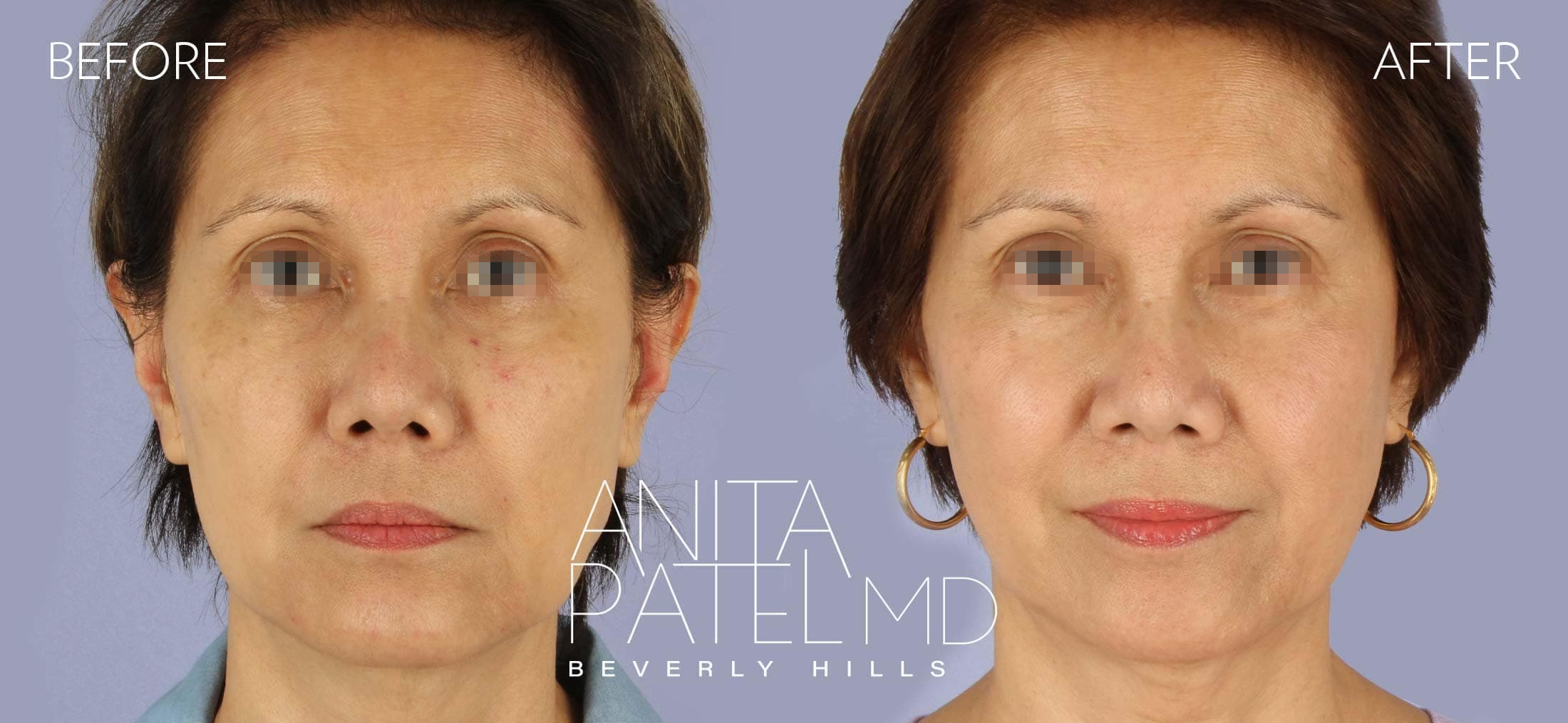 IPL Photofacial before and after — Patient 4, photo 1 of 4 — Dr. Anita Patel, MD, FACS, Beverly Hills