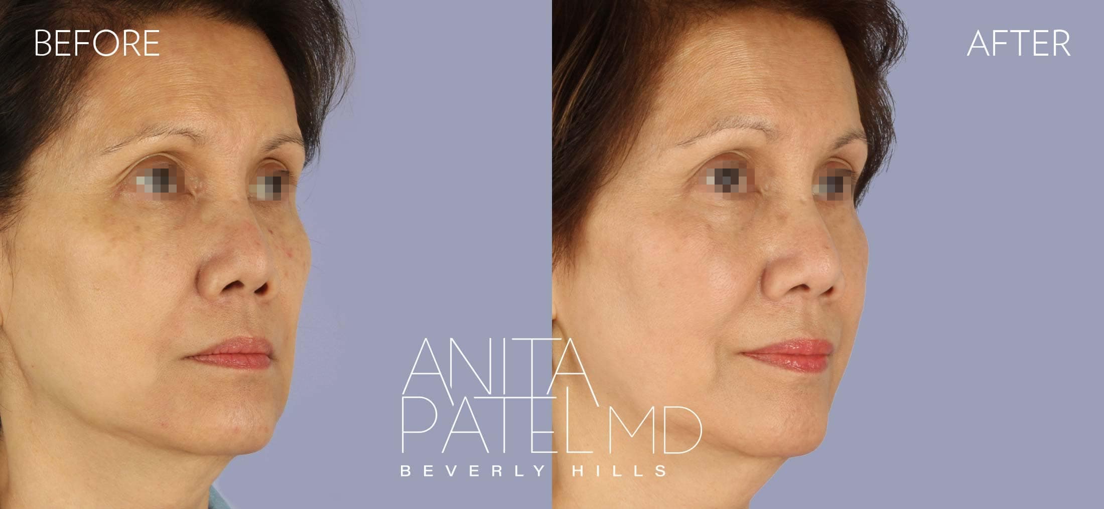 IPL Photofacial before and after — Patient 4, photo 2 of 4 — Dr. Anita Patel, MD, FACS, Beverly Hills